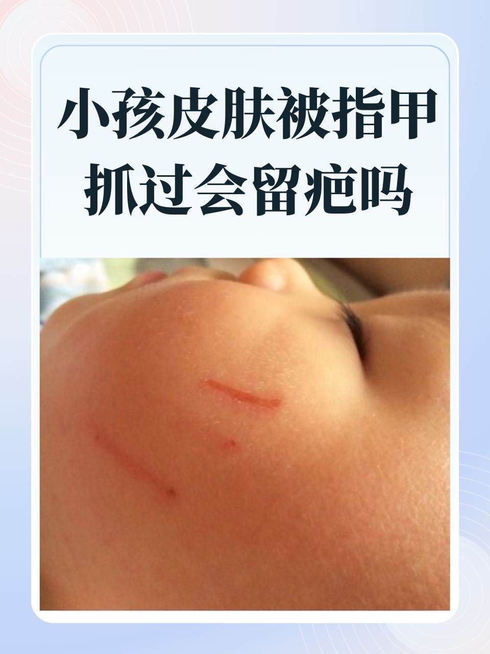 道道指甲抓痕,家长们总是忧心忡忡,担心这些伤痕会不会留下永久的疤痕