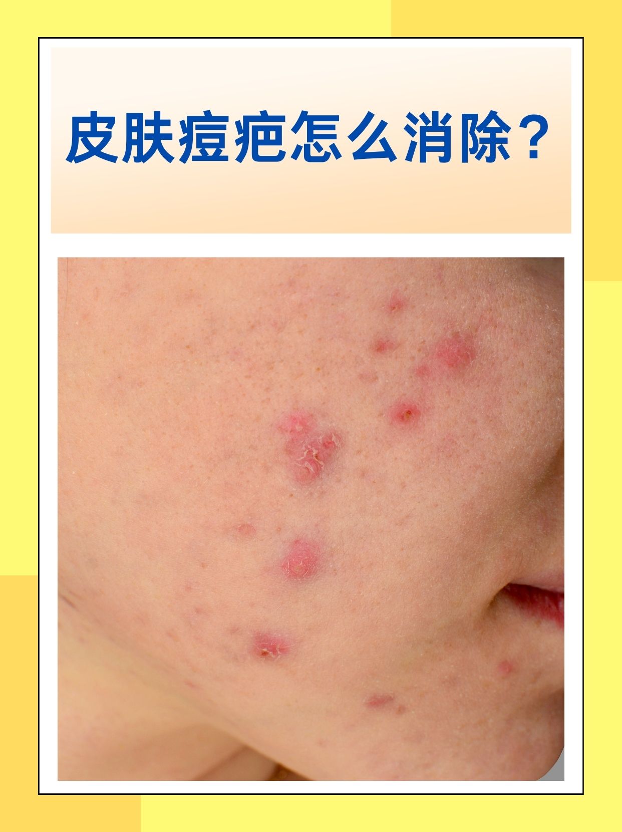 那么,皮肤痘疤该如何消除呢?下面我们一起来了解有效的消除方法