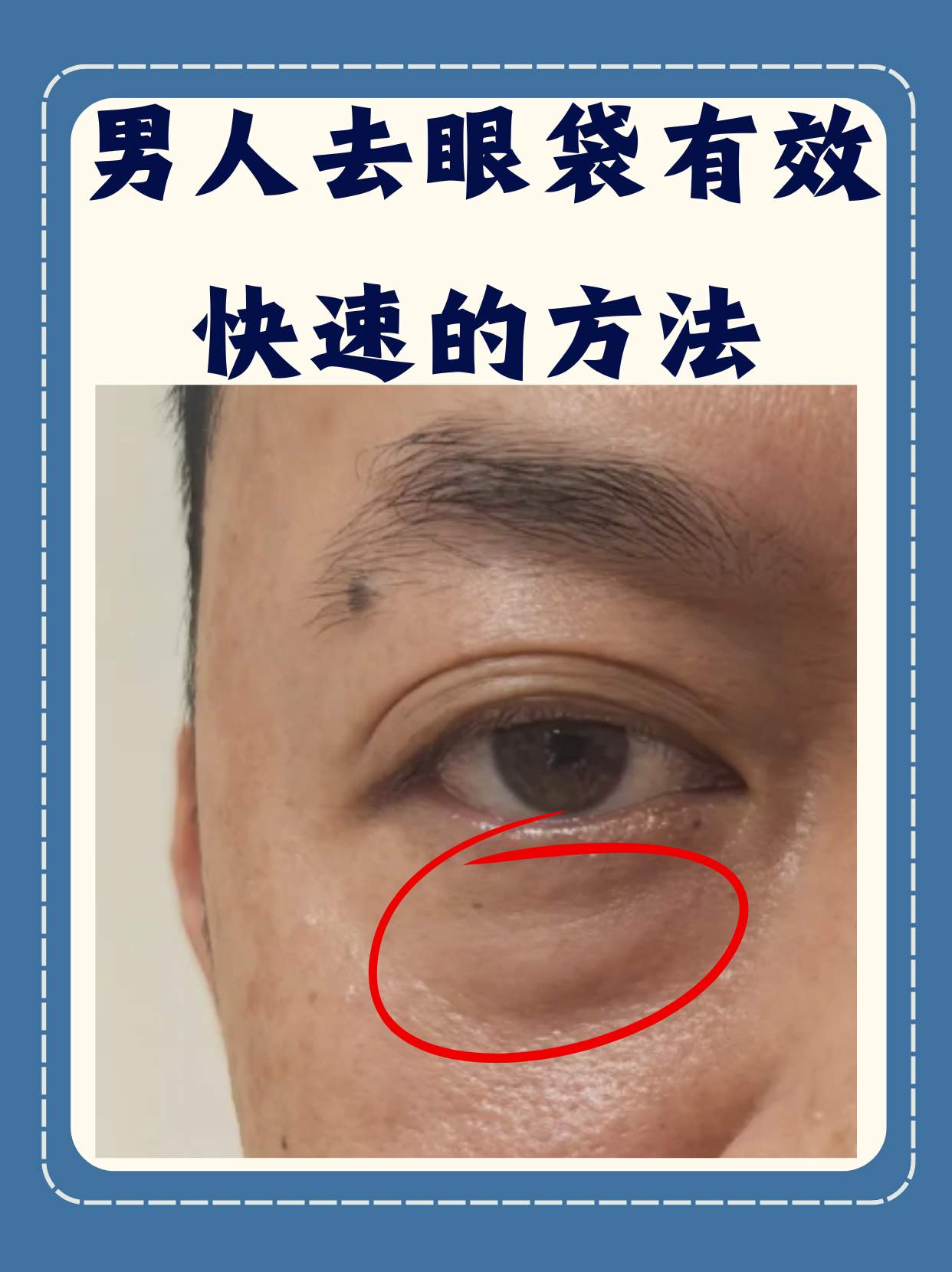 医生不建议去眼袋为什么在线