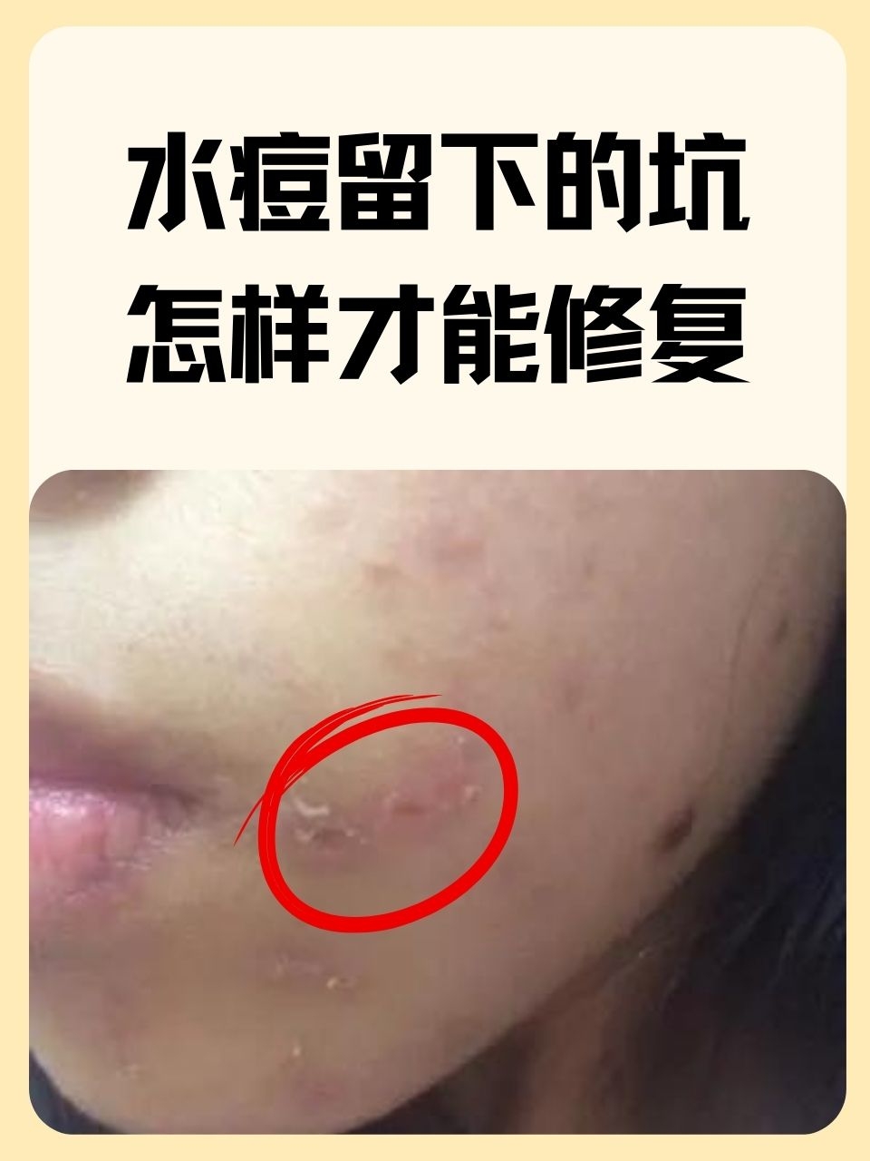 在成长的道路上,水痘或许是我们童年记忆中不可避免的一课