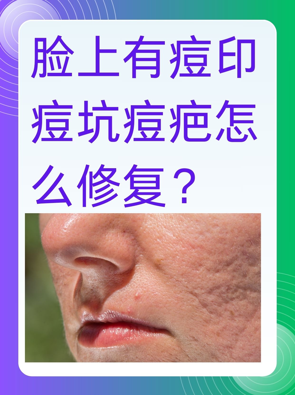 脸上的痘印,痘坑和痘疤常常让人困扰,不仅影响美观,还可能对心理