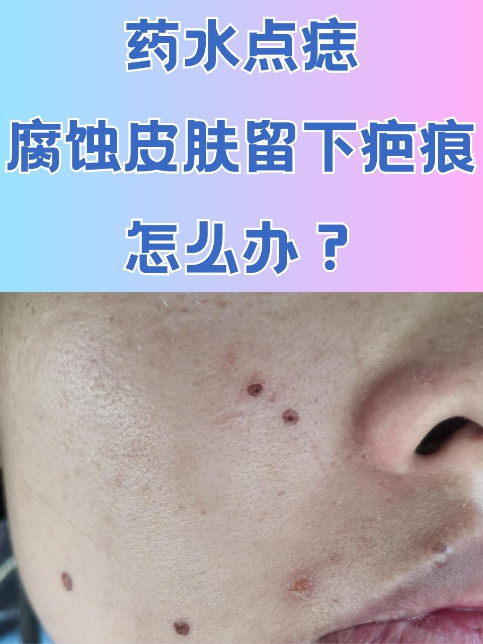 药水点痣腐蚀皮肤留下疤痕怎么办