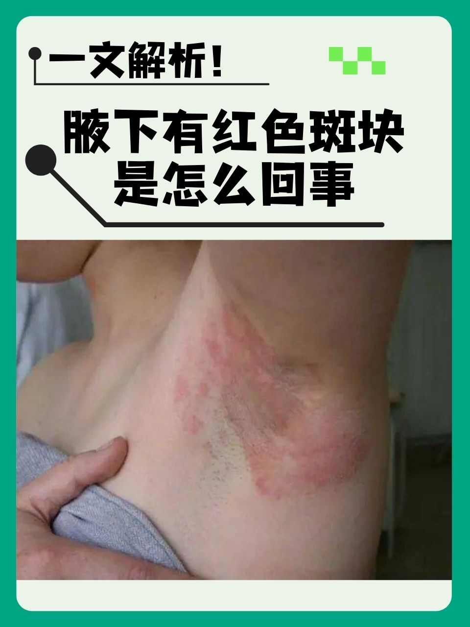 长期摩擦:长期穿着过紧的衣物,会对腋下产生摩擦,导