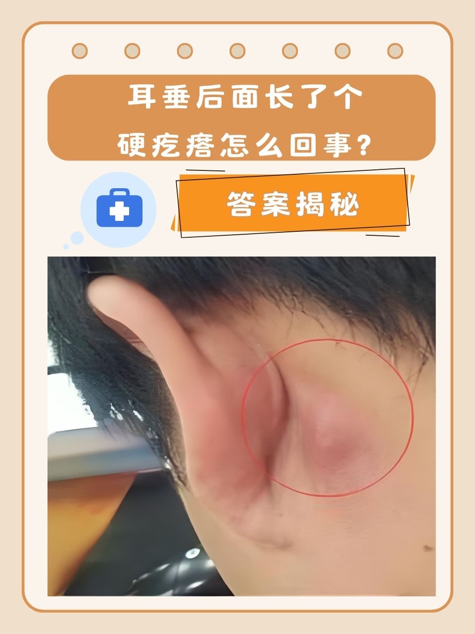 图片耳朵后面长了个硬疙瘩耳后囊肿耳后淋巴结肿大图片耳后皮脂腺囊肿