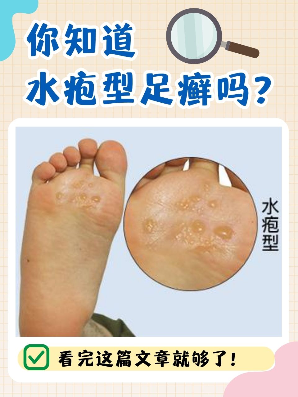 它是一种由皮肤癣菌感染足部皮肤所引发的常见浅部真菌性皮肤病,在