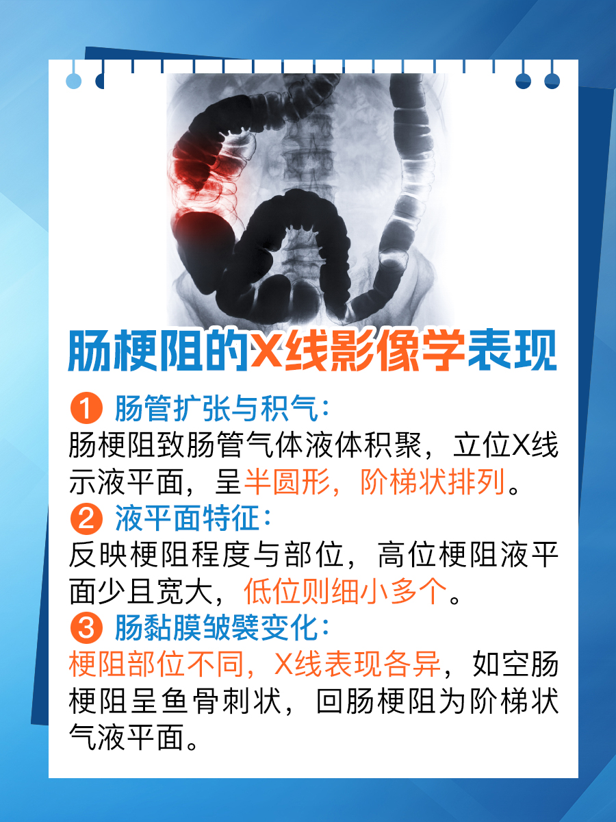 肠梗阻x线影像揭秘:快速识别.@li志强医生的动态