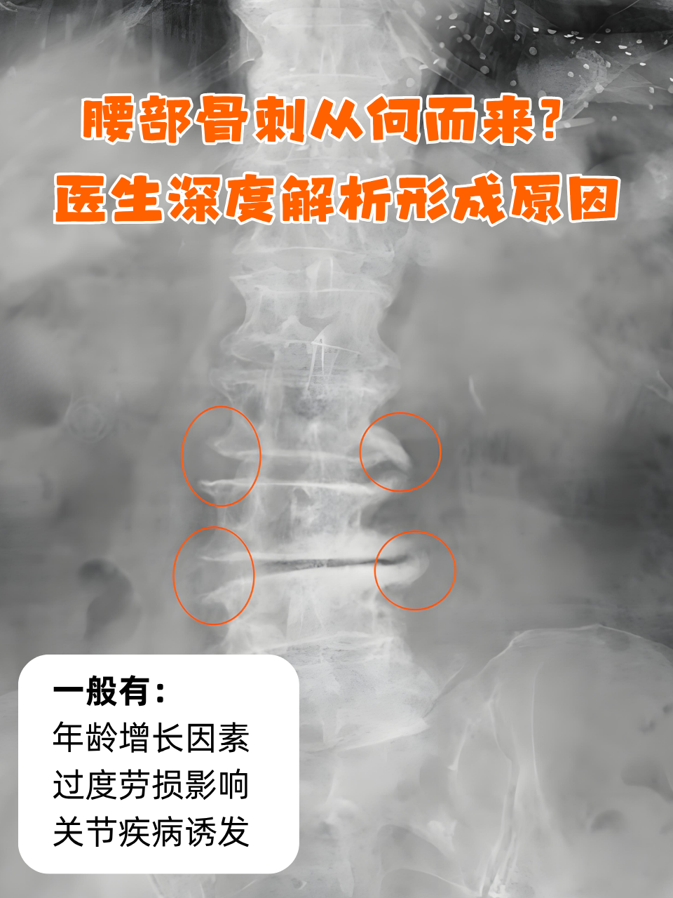 包含为什么会长骨刺是什么原因引起的的词条