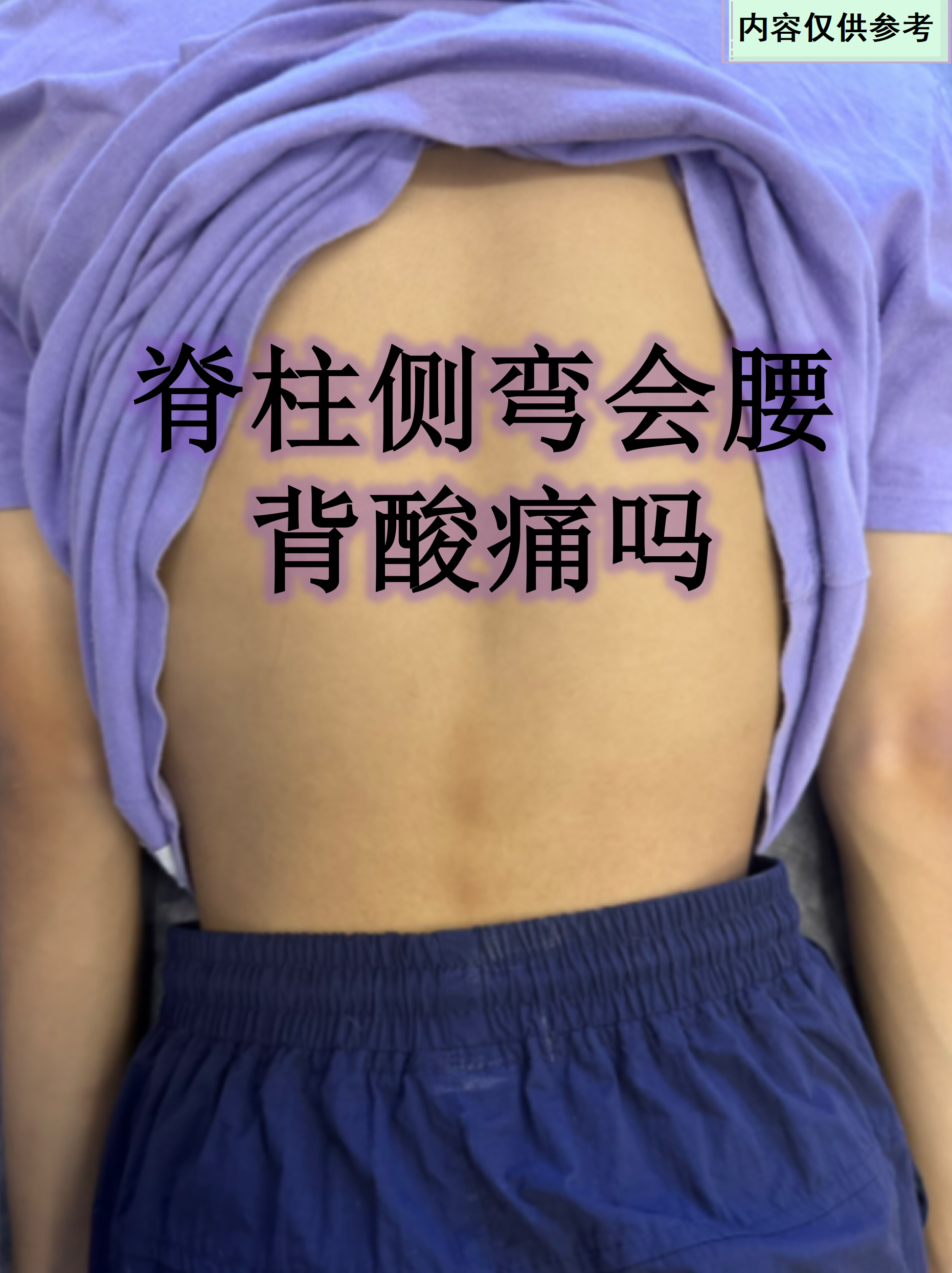 脊柱侧弯确实可能引起腰背酸痛,尤其是当脊柱
