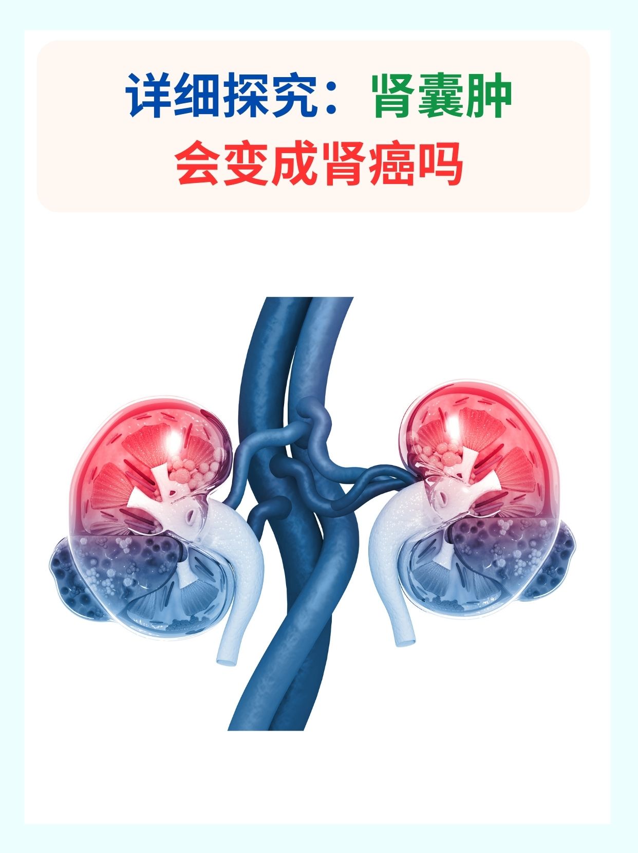 为什么会肾囊肿 为什么会肾囊肿