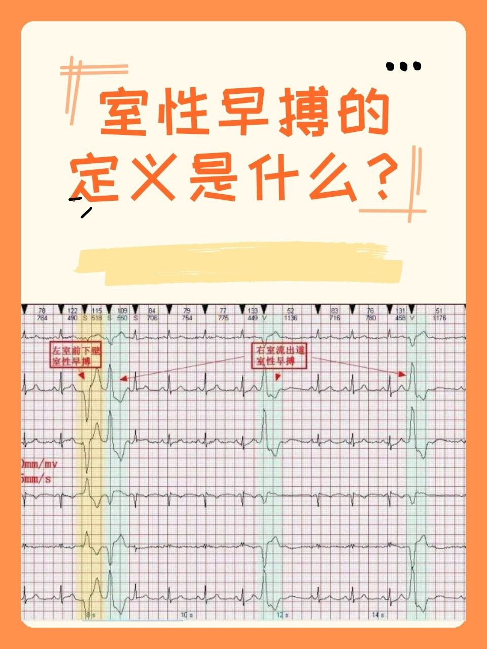 频发房性早搏图片图片