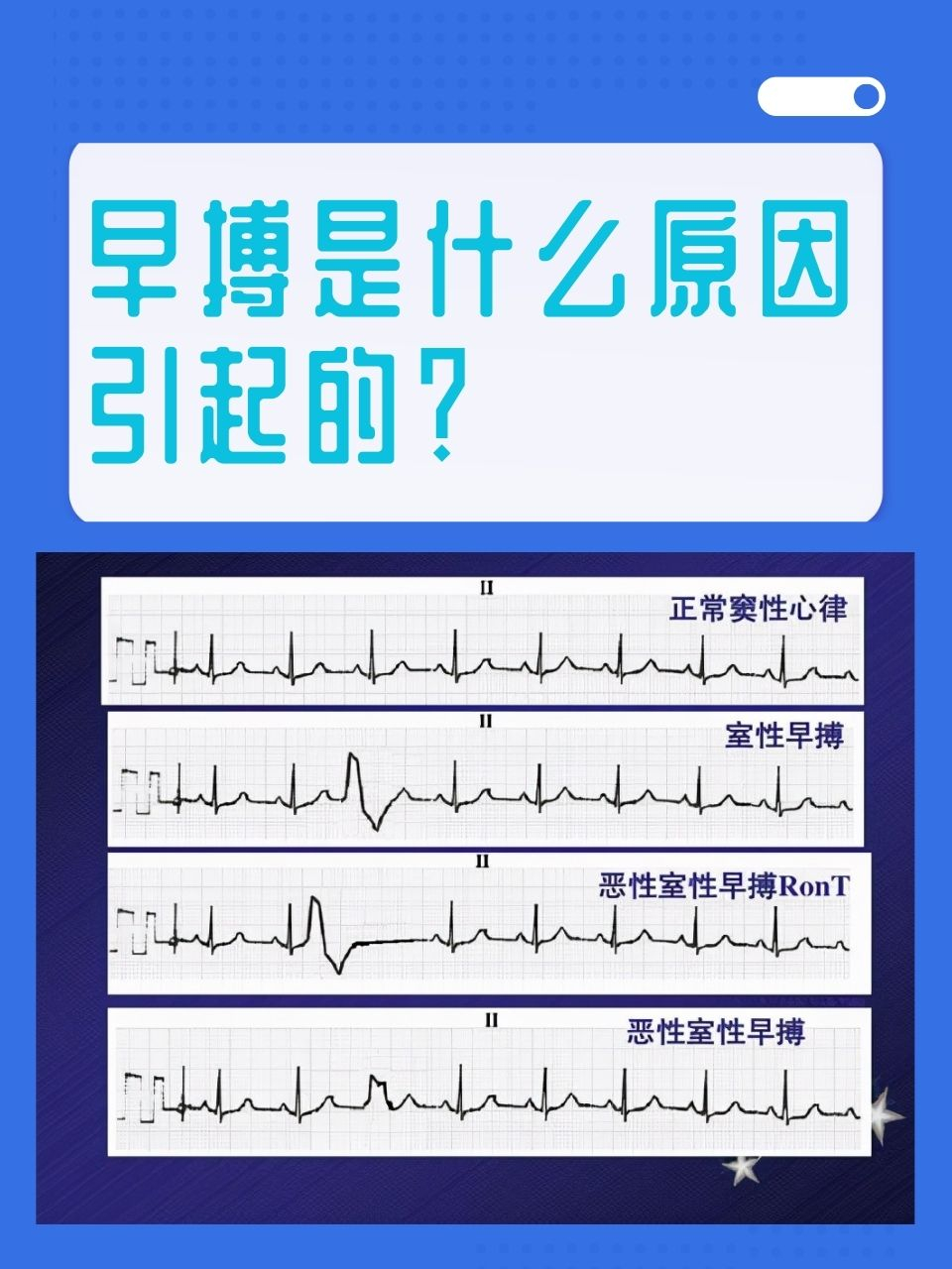 早搏,是我们日常生活中可能遇到的一种心脏"小插曲".