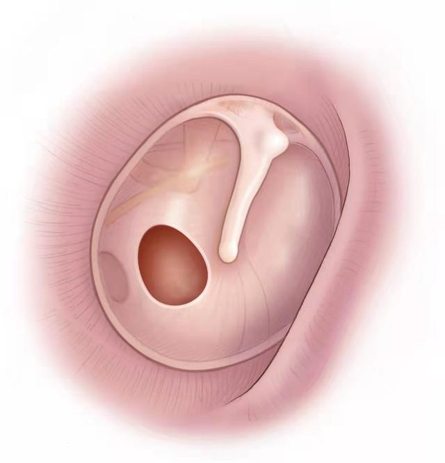 鼓膜穿刺位置图片