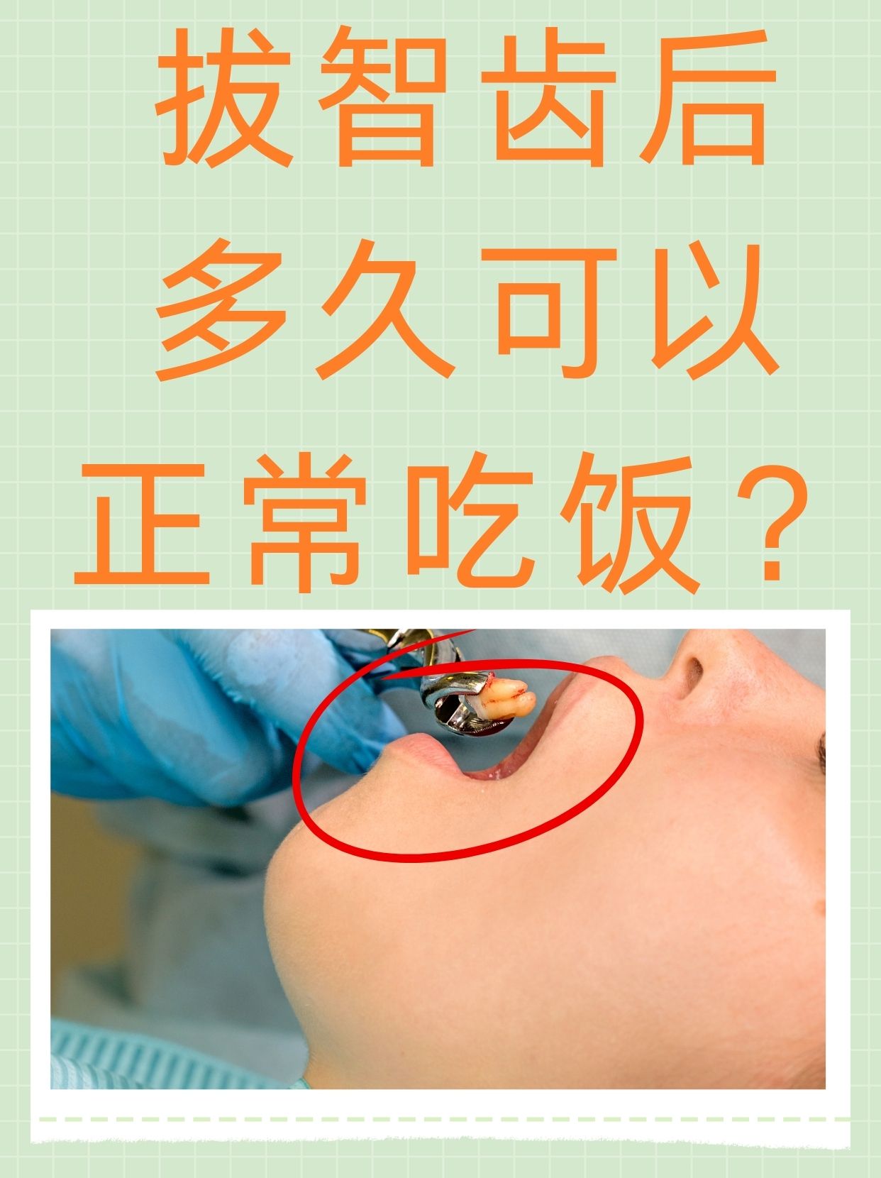 当智齿出现疼痛,发炎或影响其他牙齿健康时,医生通常会建议拔除智齿