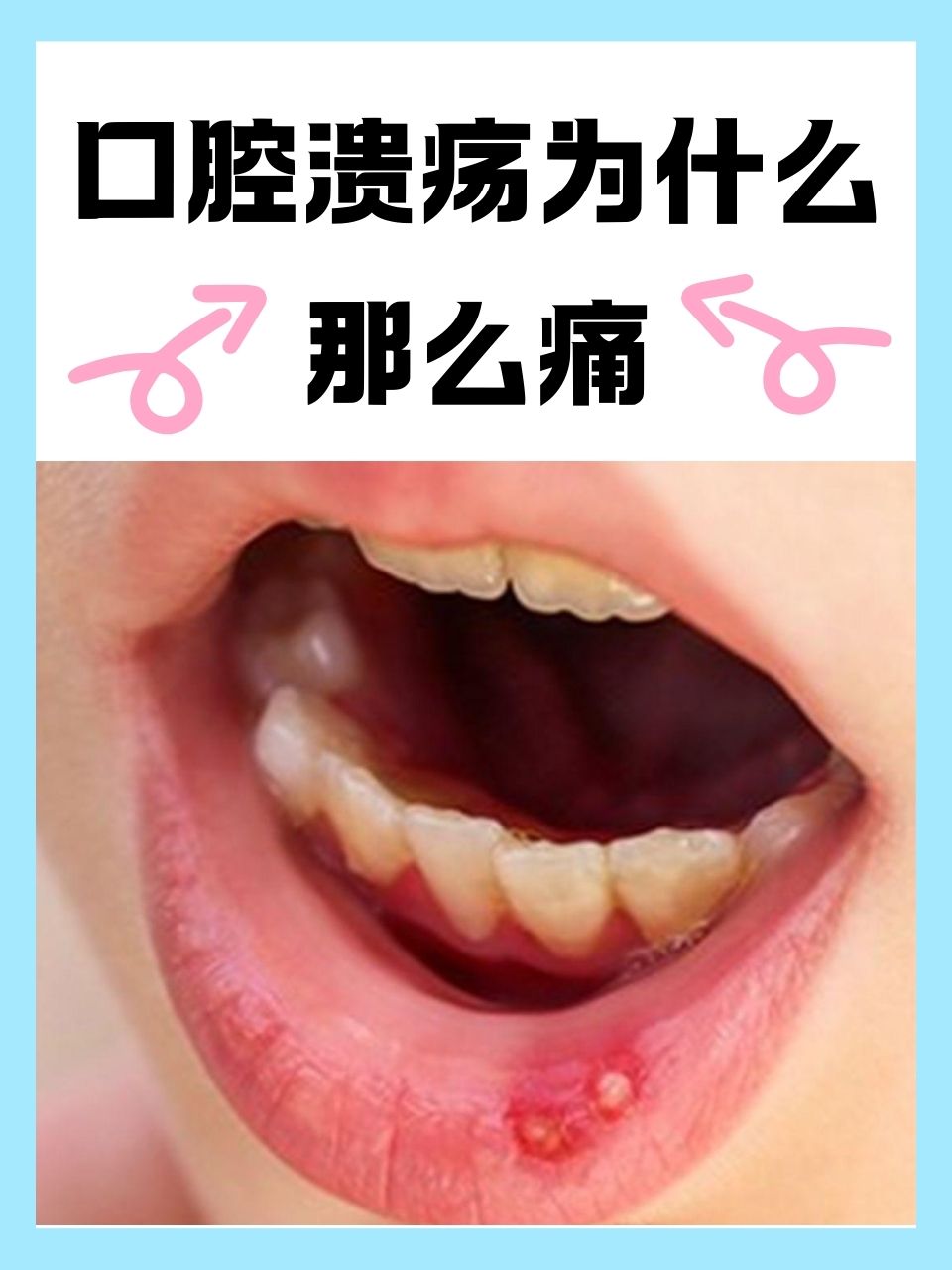 为什么总是口腔溃疡