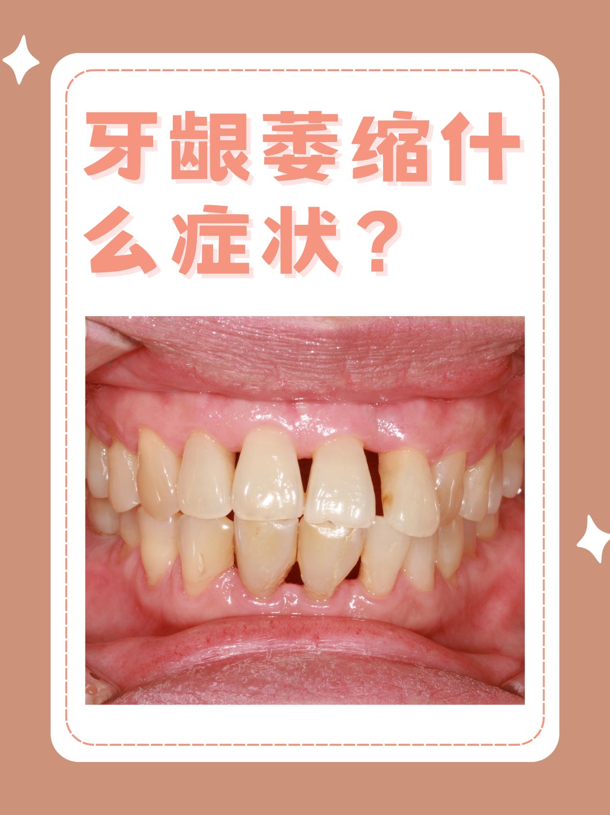 为什么会牙龈萎缩的原因为什么在线 为什么会牙龈萎缩的原因为什么在线