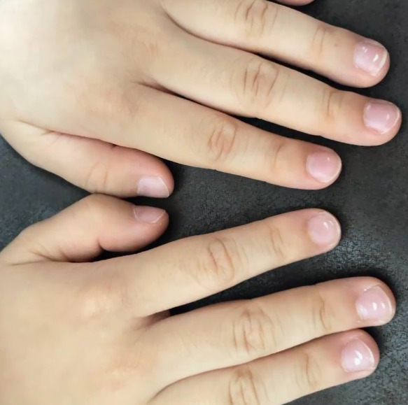 家长发现孩子指甲上出现白点会紧张其实这可能是常见的"点状白甲症"