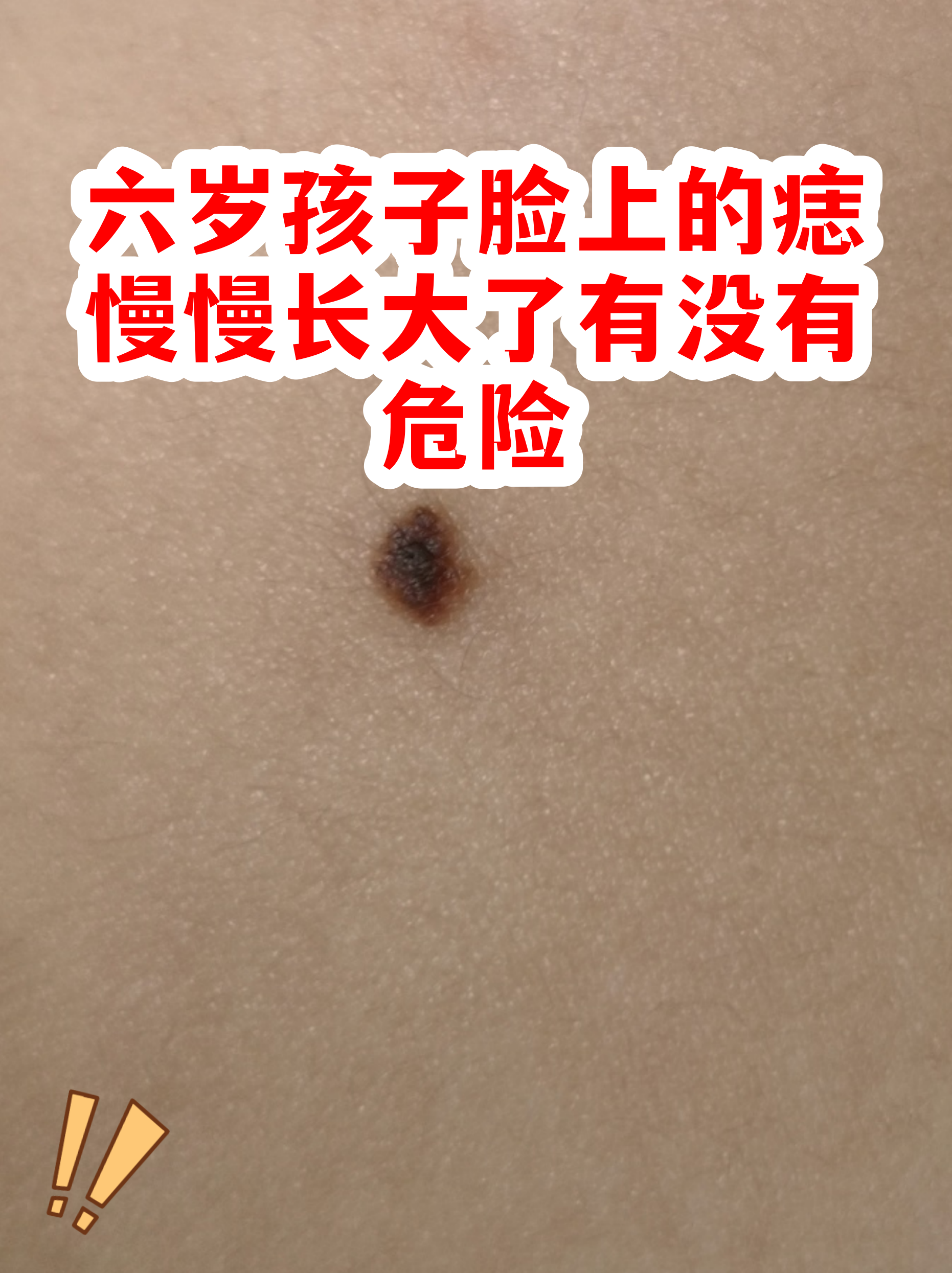 六岁孩子脸上的痣慢慢长大了有没有危险