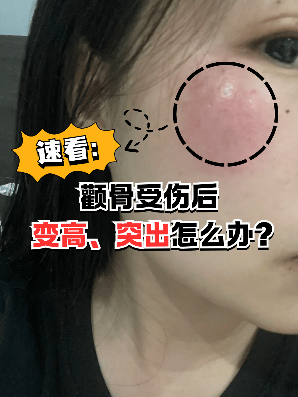 颧骨骨折面部凹陷图片面部骨裂颧骨骨纤维异常增殖症图片脸部摔伤骨不