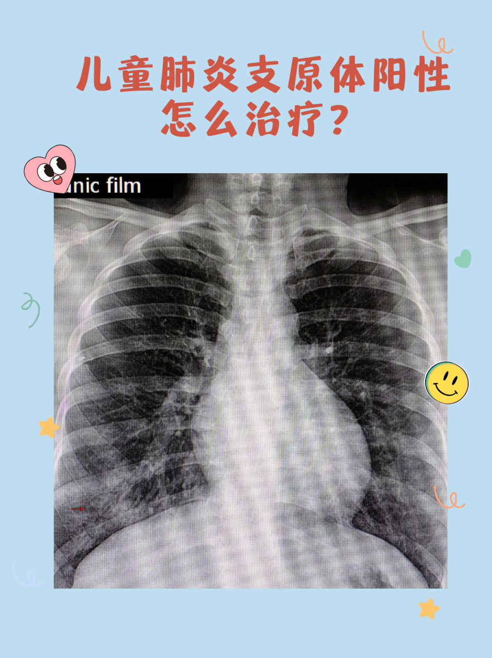 检查出儿童支原体阳性,该如何治疗?