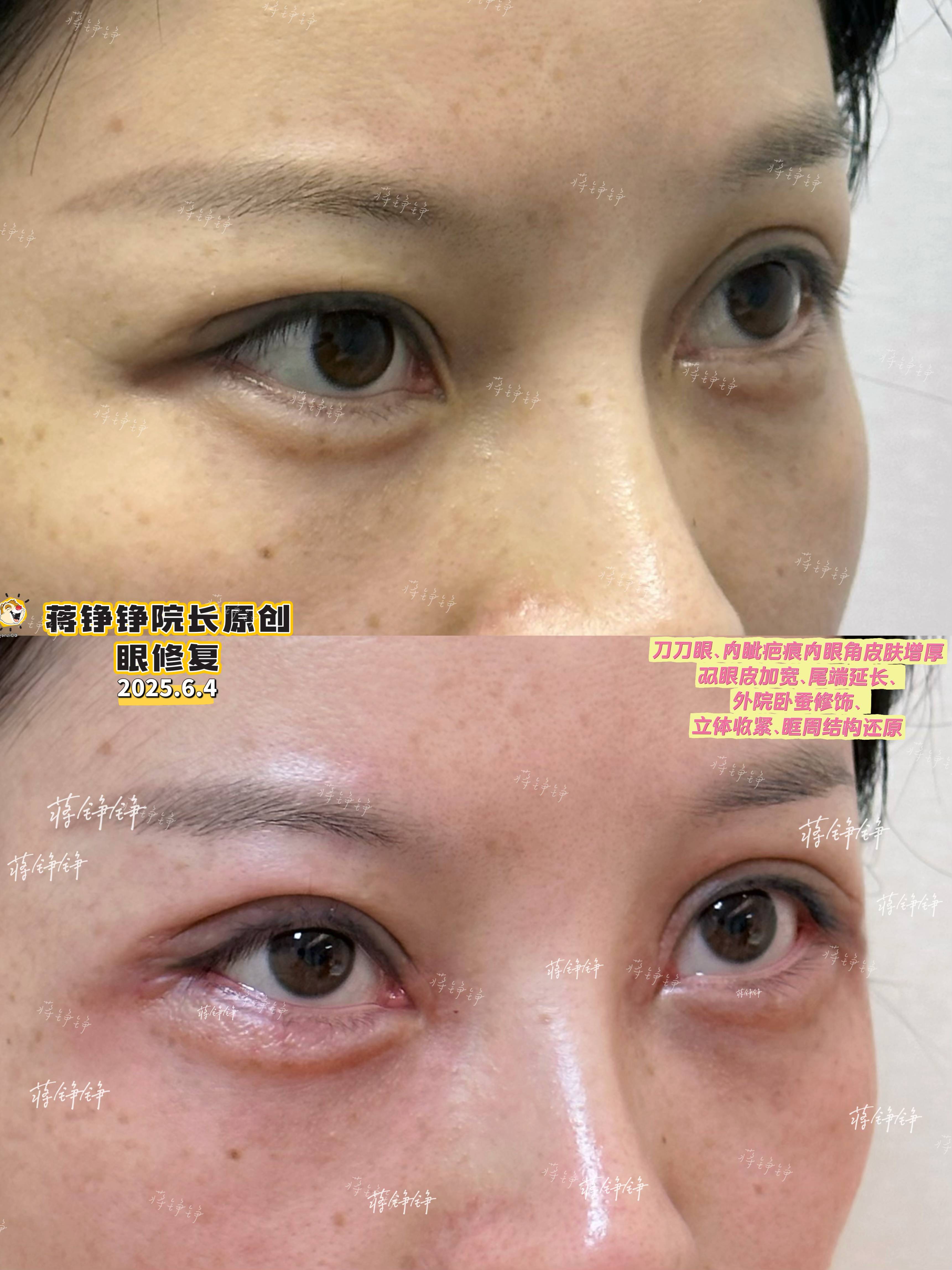 眉压眼显凶,眼周内眦怎么改善?