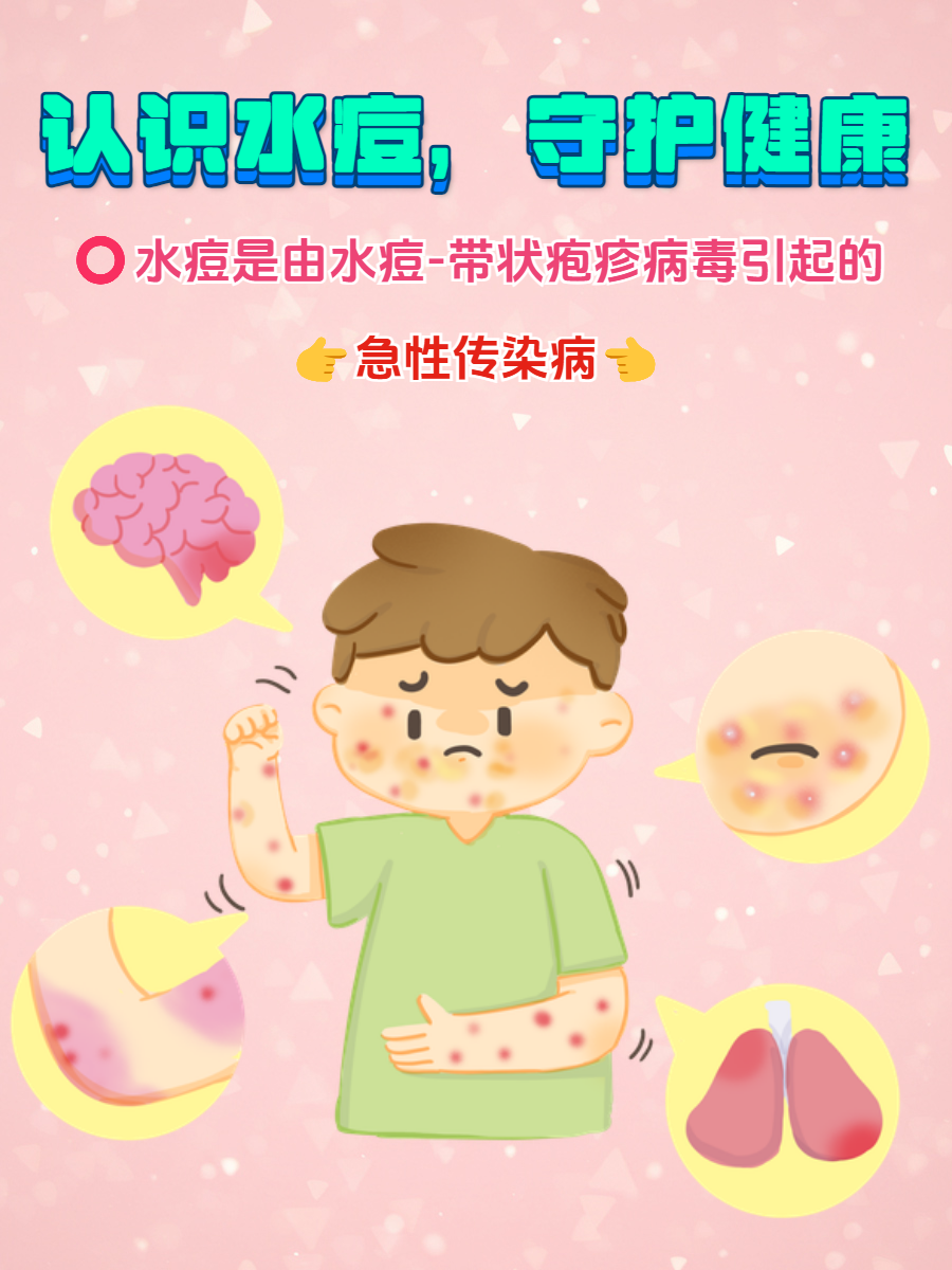 水痘是一种常见的急性传染病,在生活中时有发生