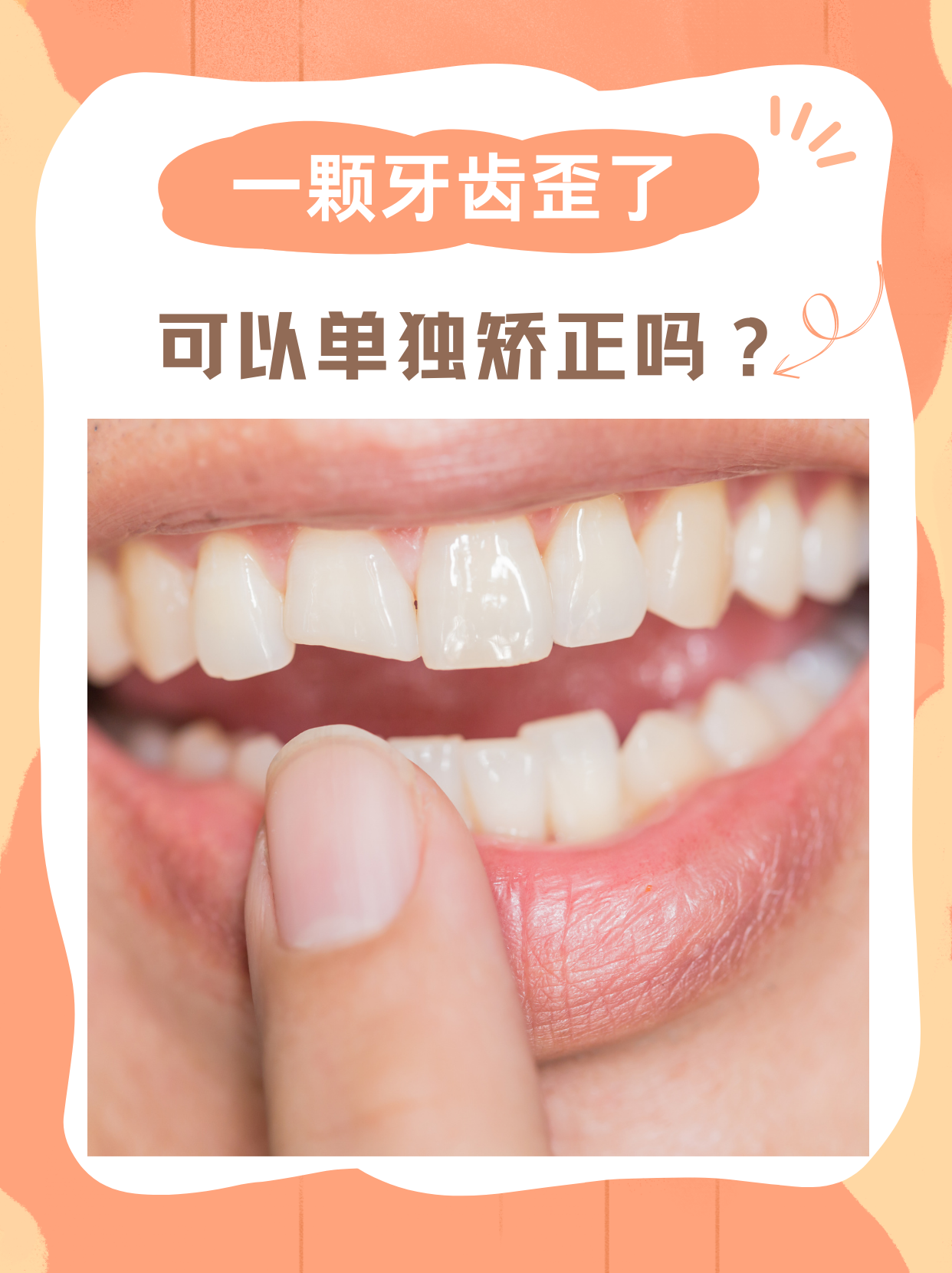 一颗牙齿歪了,可以单独矫正吗?