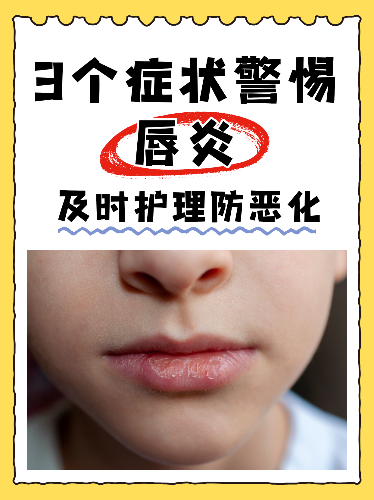 为什么会得唇炎 为什么会得唇炎