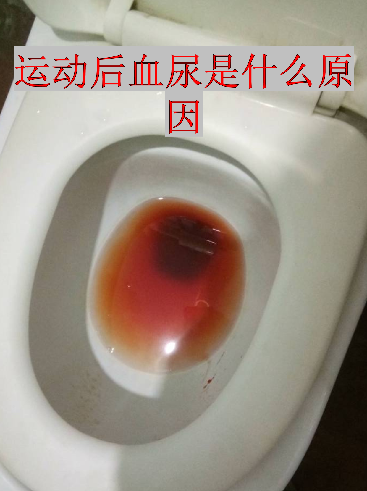 运动后血尿是什么原因