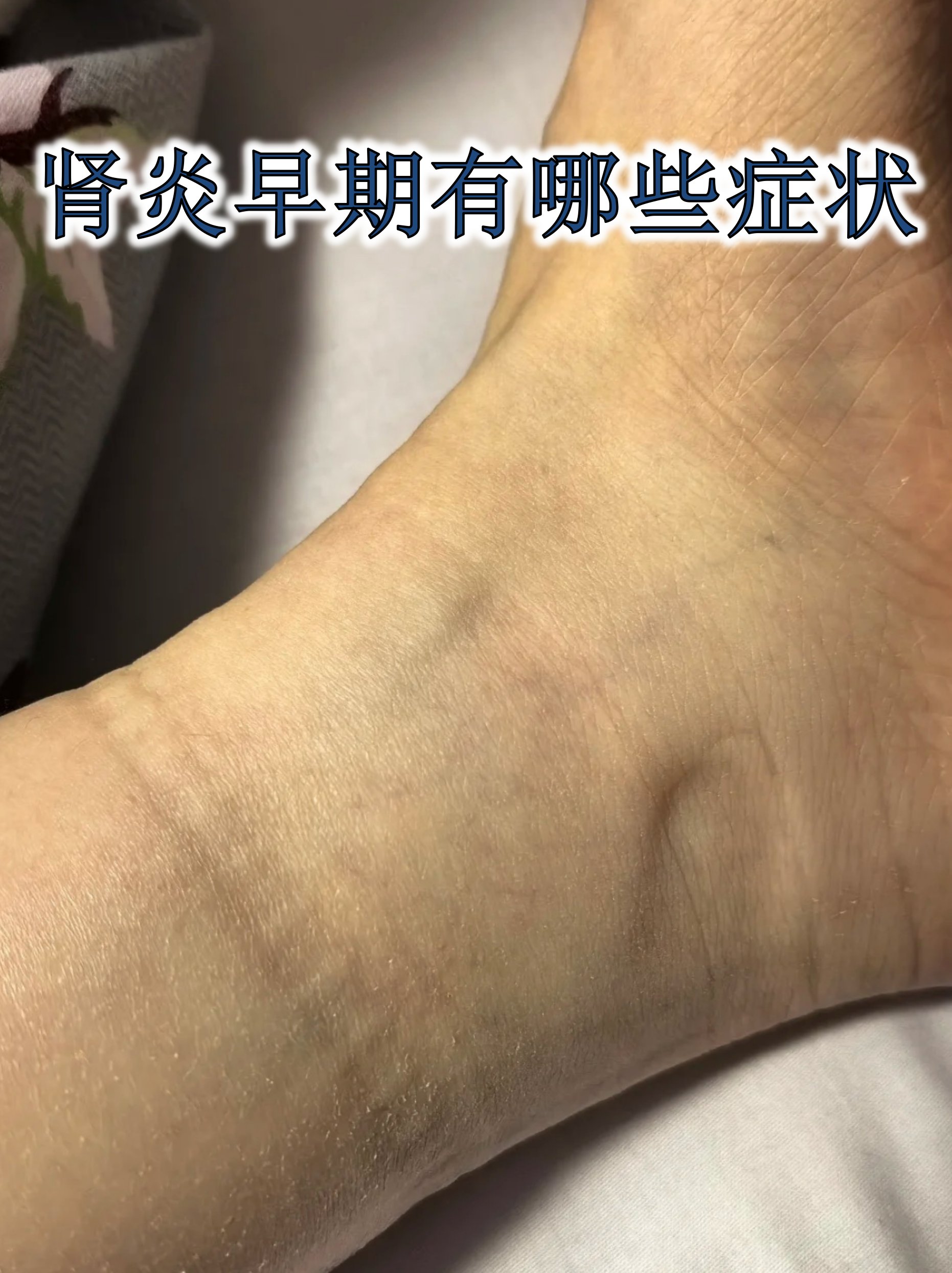 肾炎早期症状 水肿表现:晨起眼睑或面部水肿