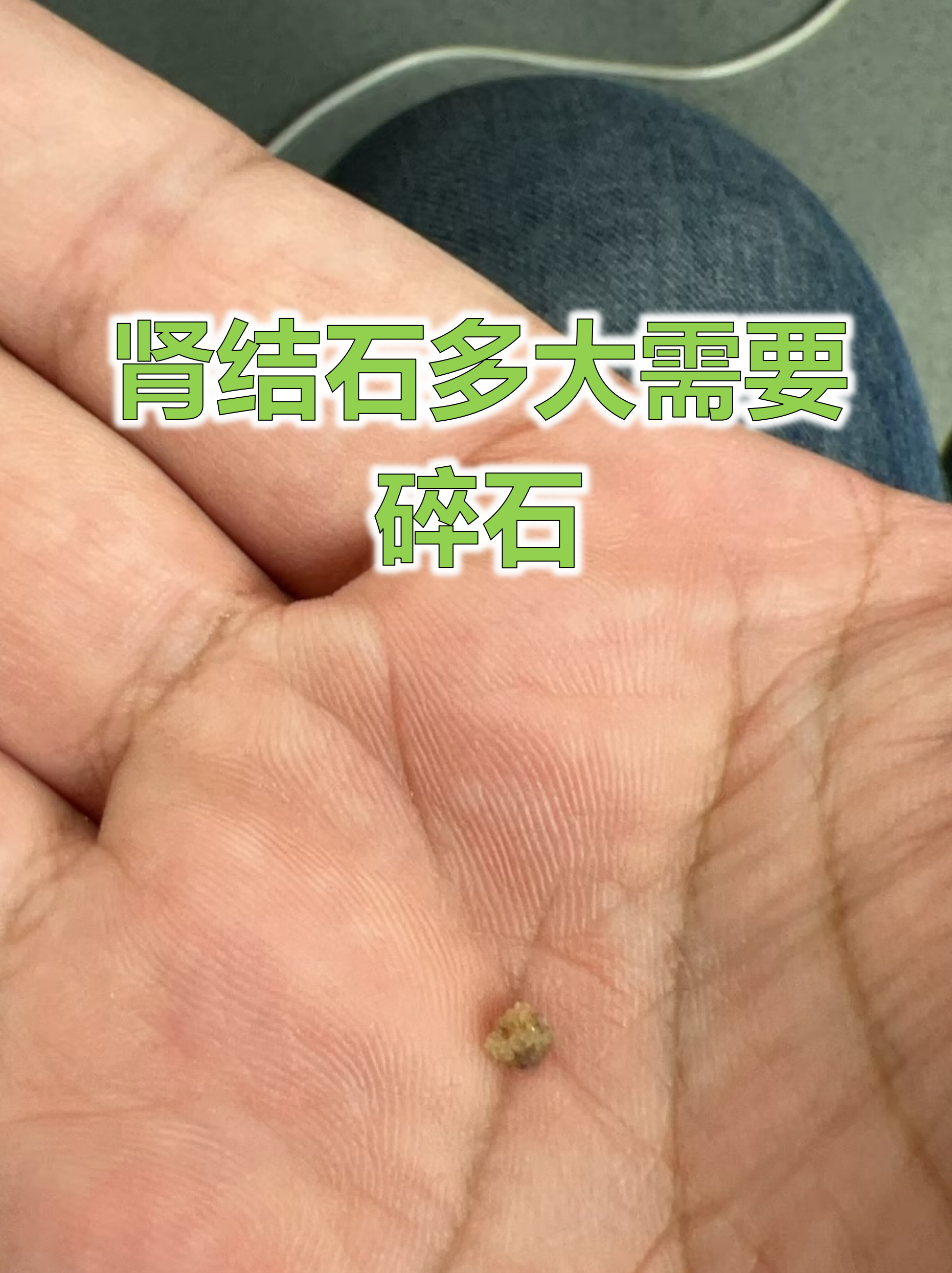 肾结石是否需要碎石治疗关键看它的大小和位置