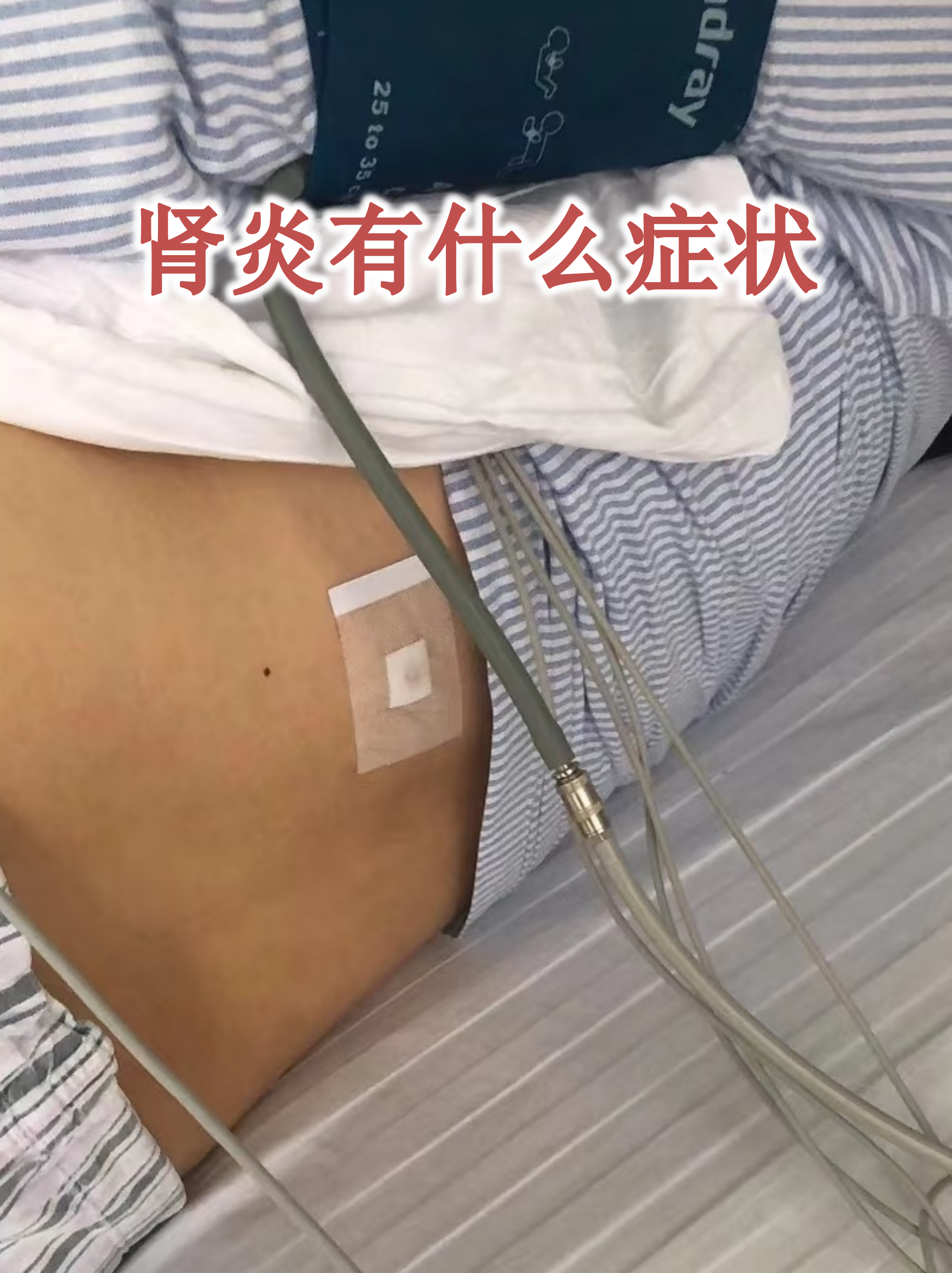 肾炎常见症状 水肿:晨起眼睑或面部水肿,久站后下肢