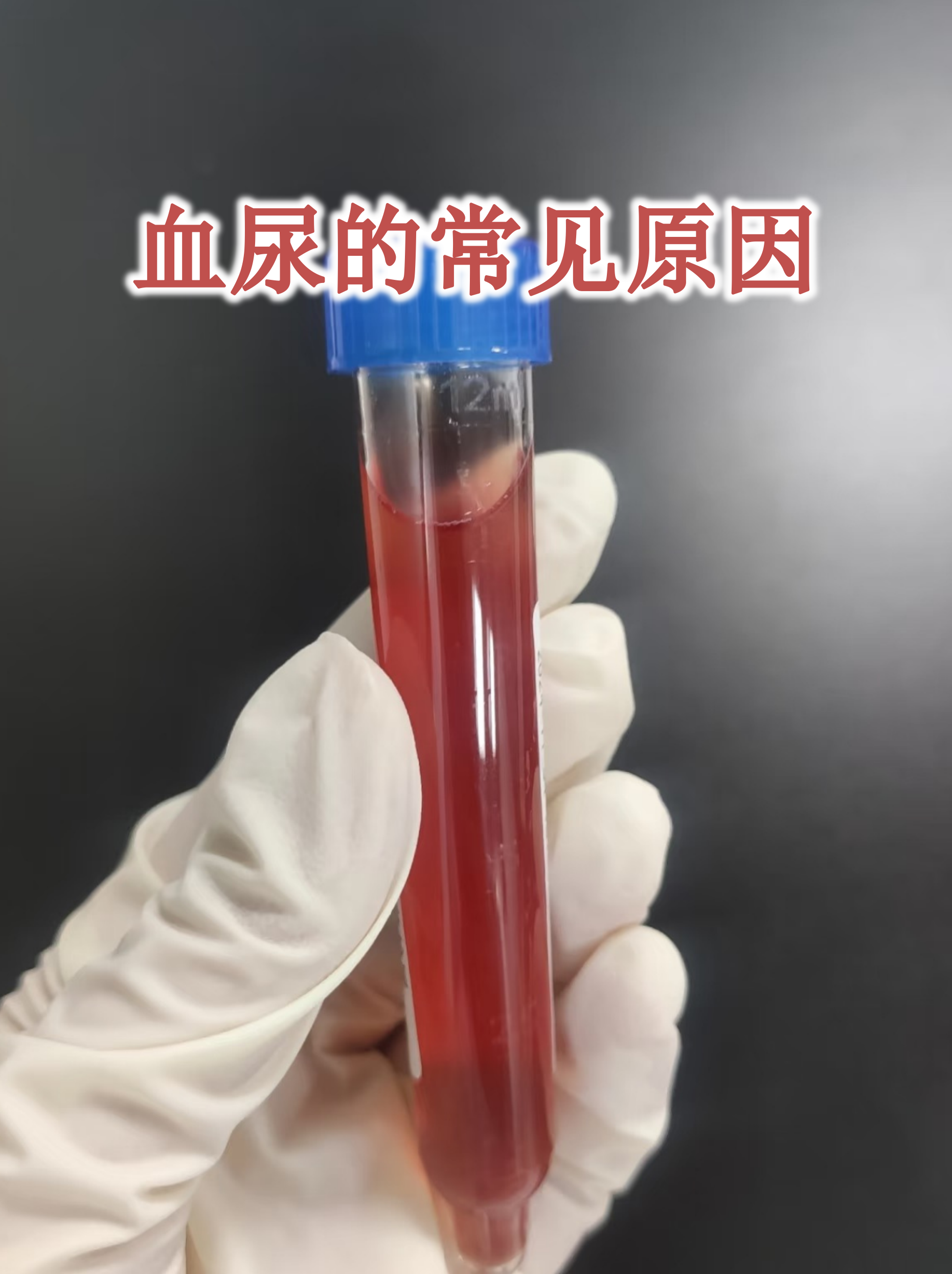 血尿是身体发出的重要警报信号,尿液呈现红色或茶色