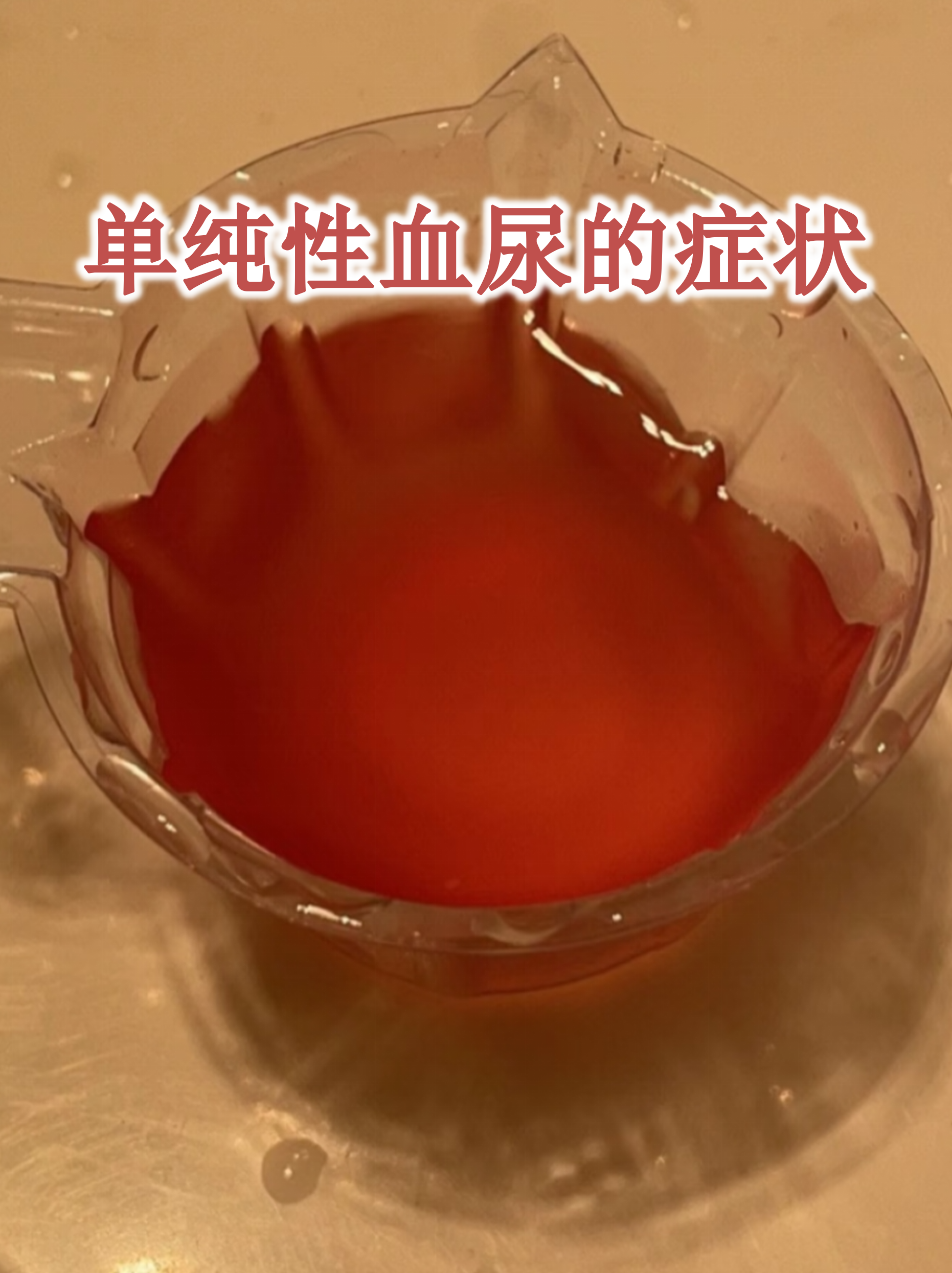 单纯性血尿的症状表现 尿色改变:尿液呈现淡红色