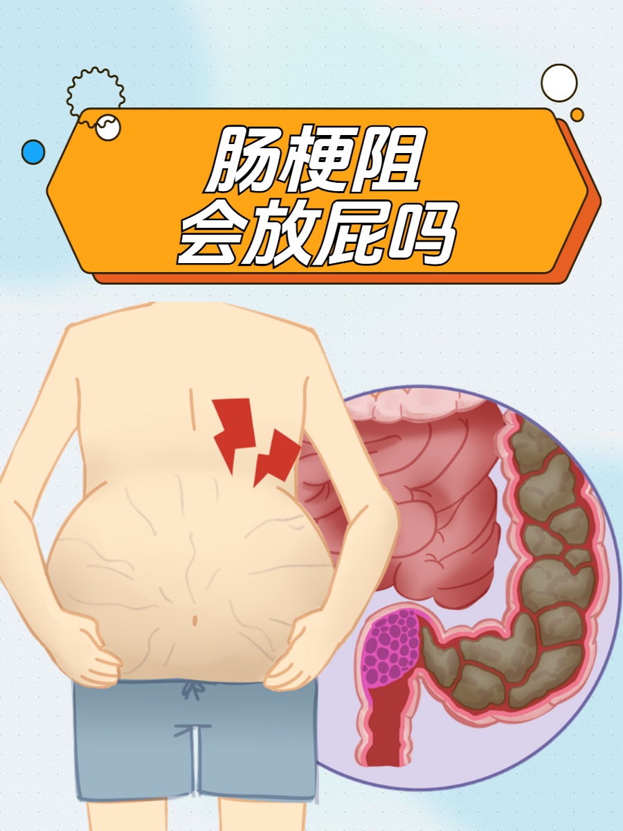 全面了解  肠梗阻是一种备受痛苦的疾病,而"肠梗阻会放屁吗?