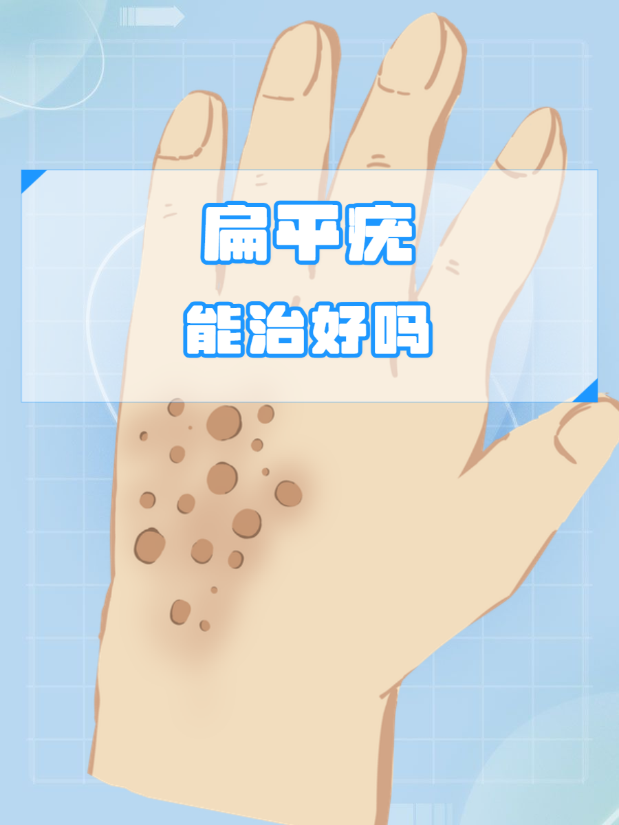 为什么会长扁平疣 为什么会长扁平疣