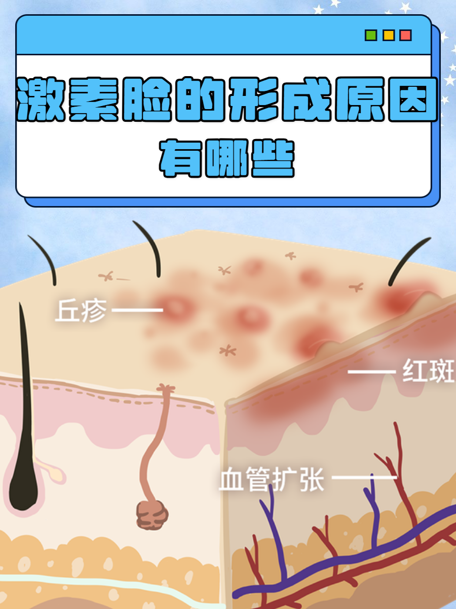 原因探究 激素脸通常是指面部激素依赖性皮炎,很多人会出现面部激素