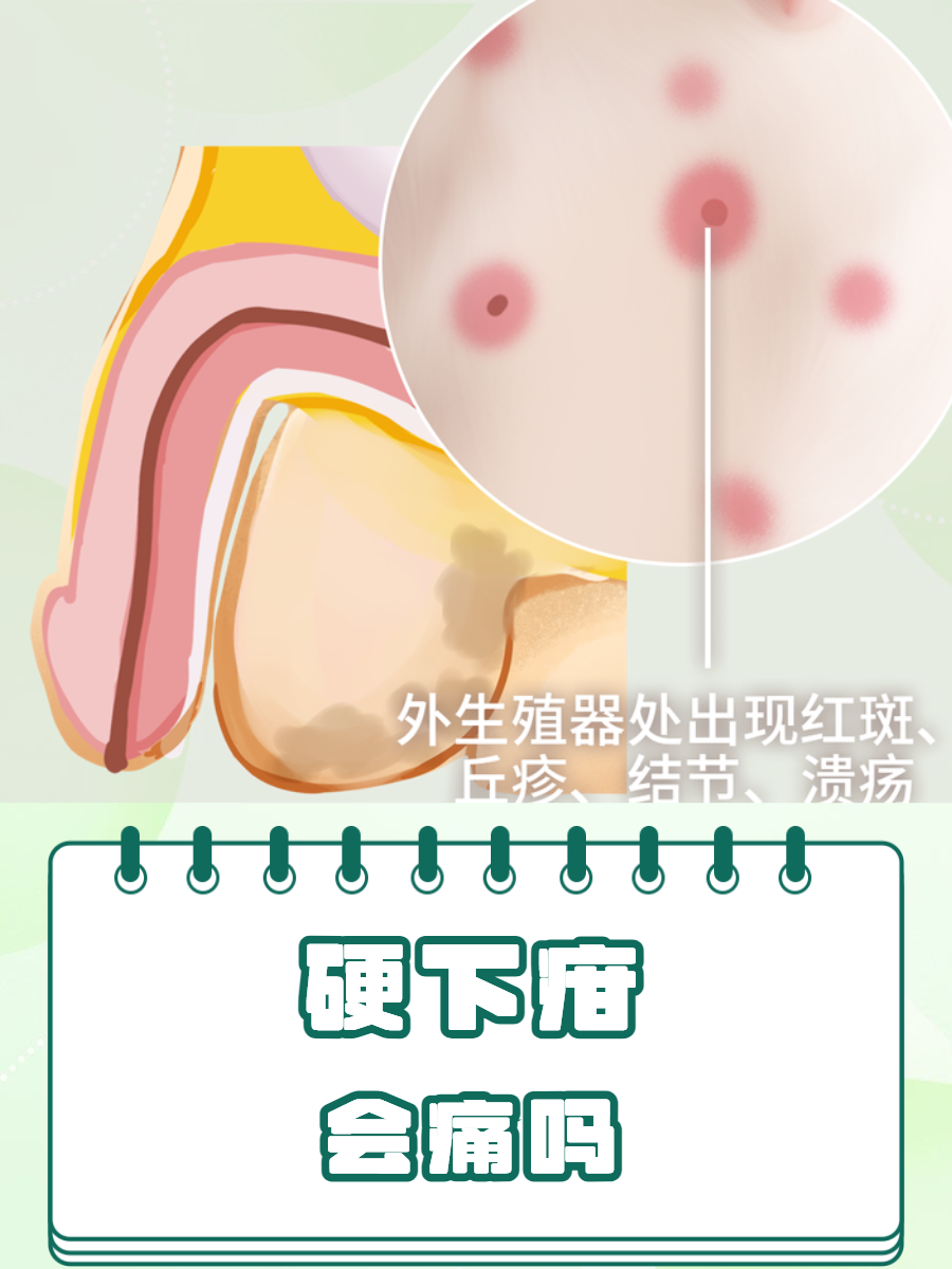 硬下疳是否伴有疼痛是一个值得探讨的关键问题