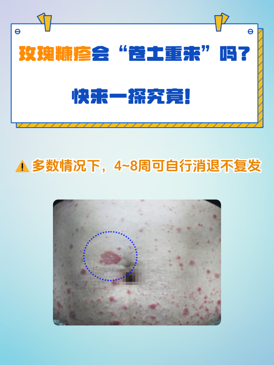 为什么会得玫瑰糠疹 为什么会得玫瑰糠疹