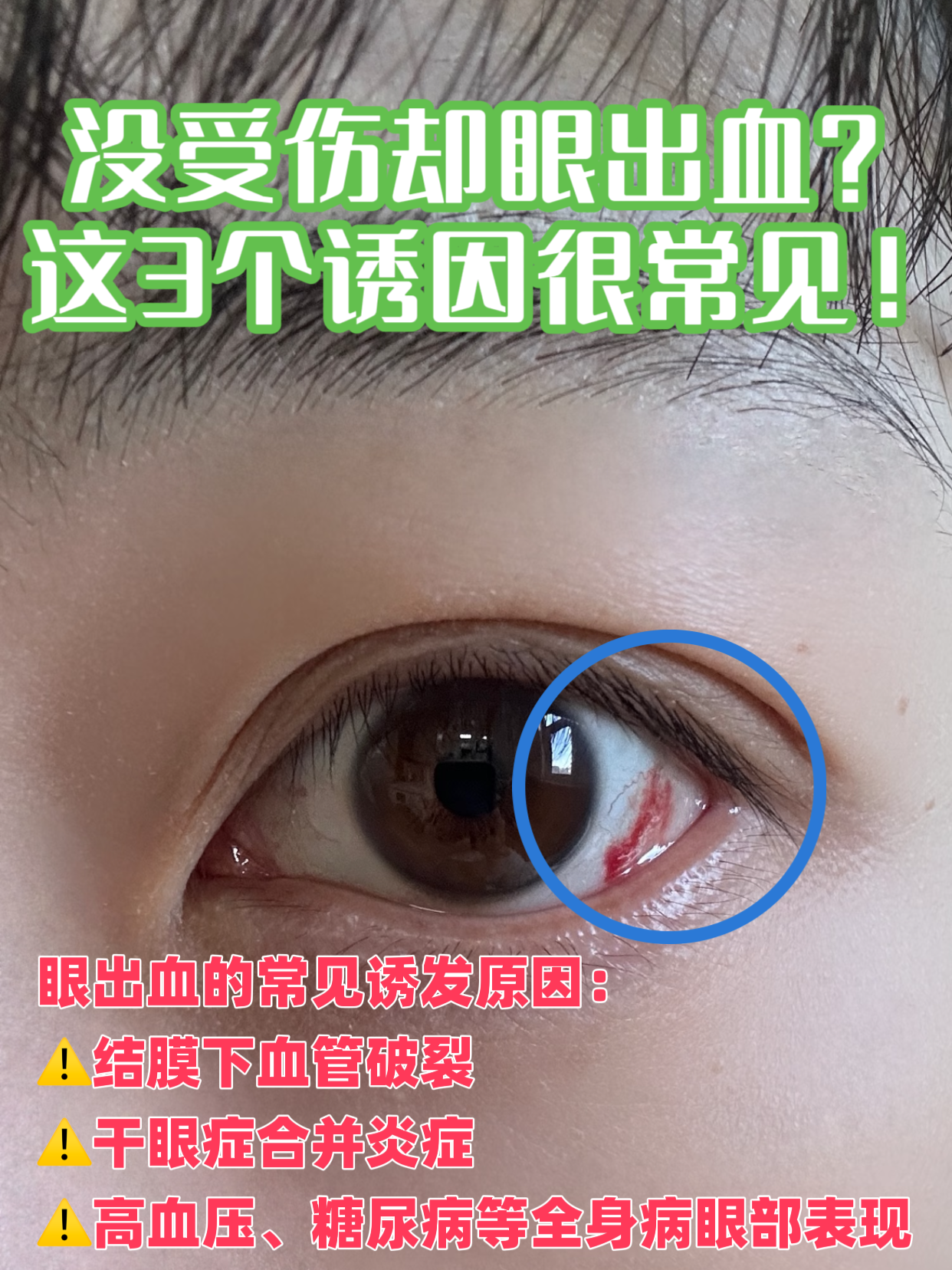 眼睛为什么会出血 眼睛为什么会出血