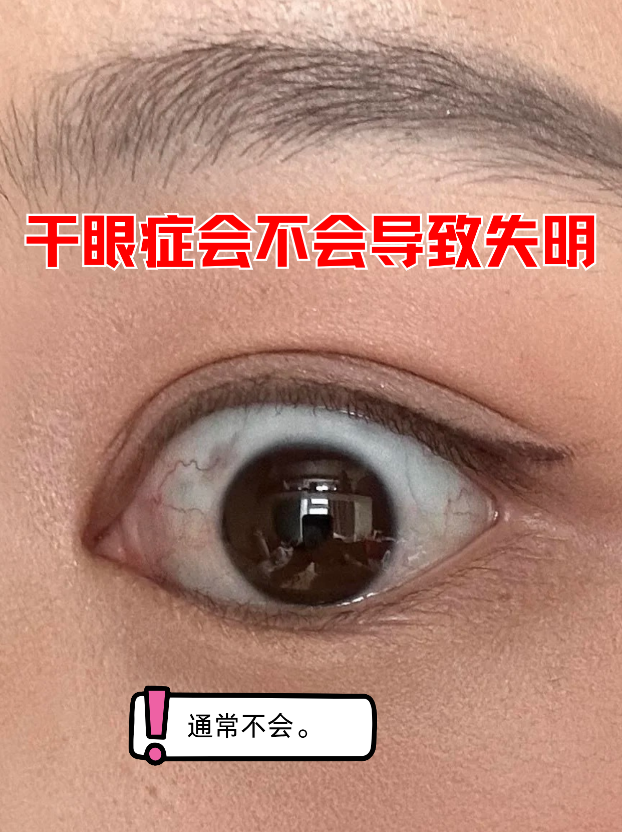 干眼症会不会导致失明