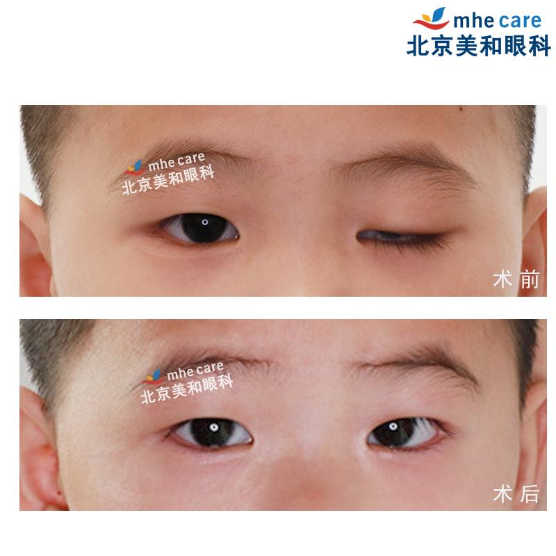 家长可预约美和线上视频会诊评估孩子上睑下垂程度