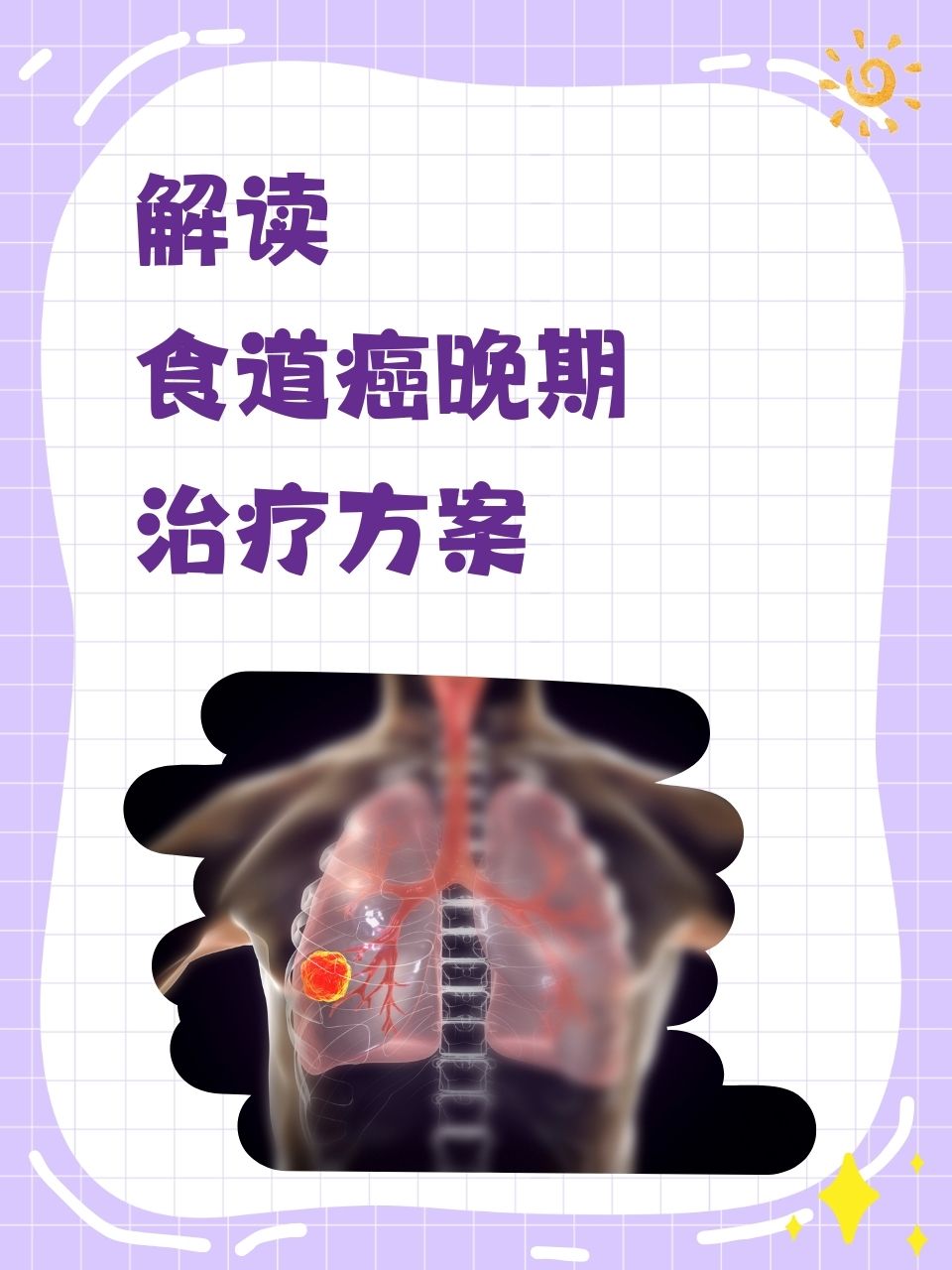 解读:食道癌晚期治疗方案  人们常常对食道癌晚期的治疗感到迷茫和无