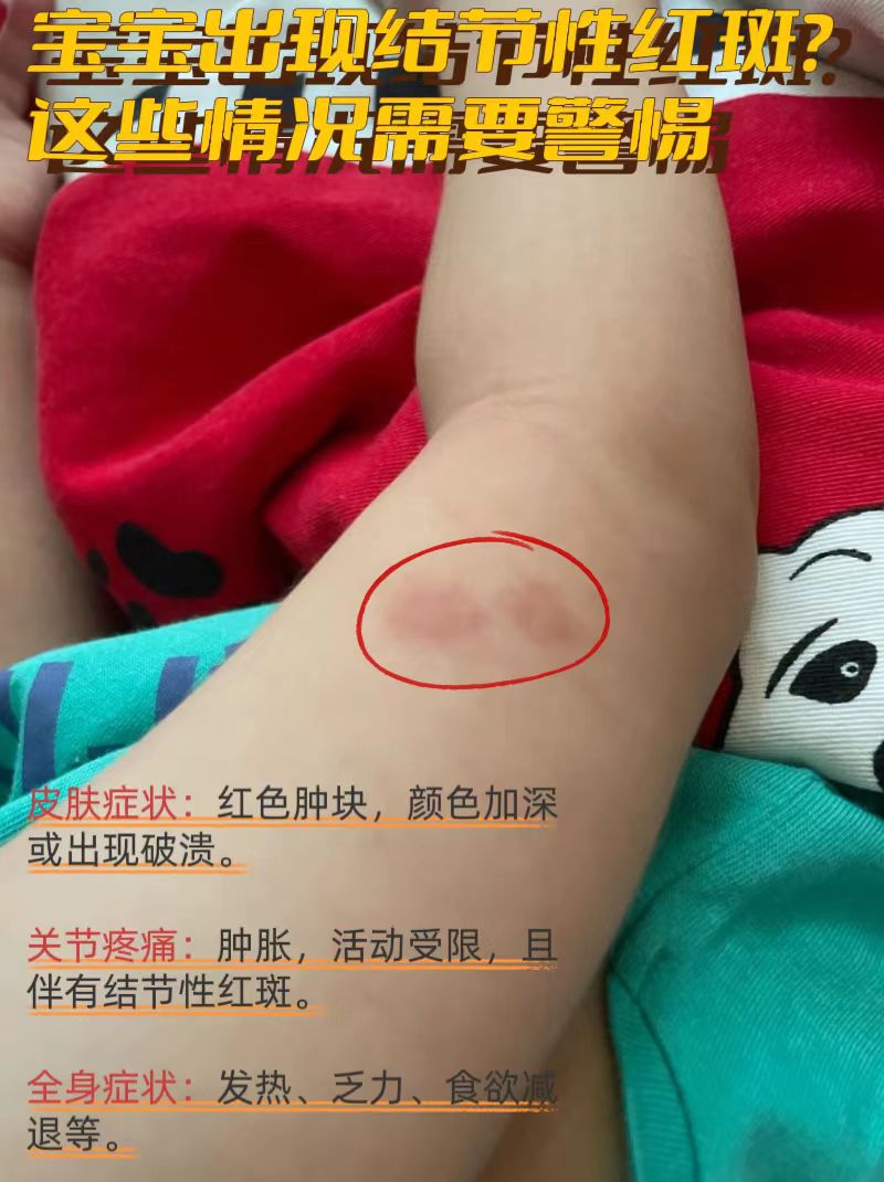 图片结节红斑儿童结节性红斑白塞病结节性红斑图片皮肤结节性红斑图片