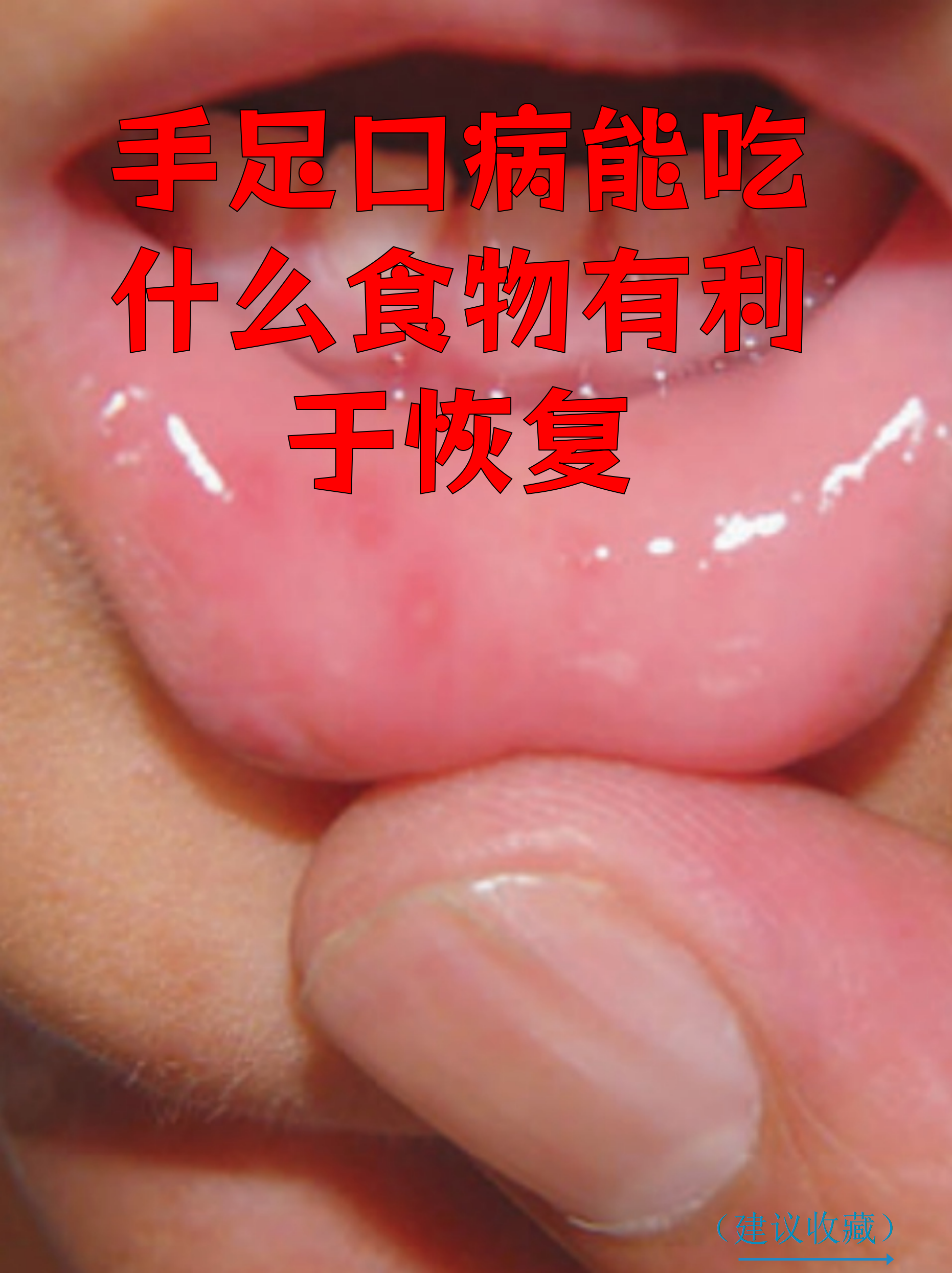 病毒感染不能吃什么食物(病毒感染不能吃什么水果)