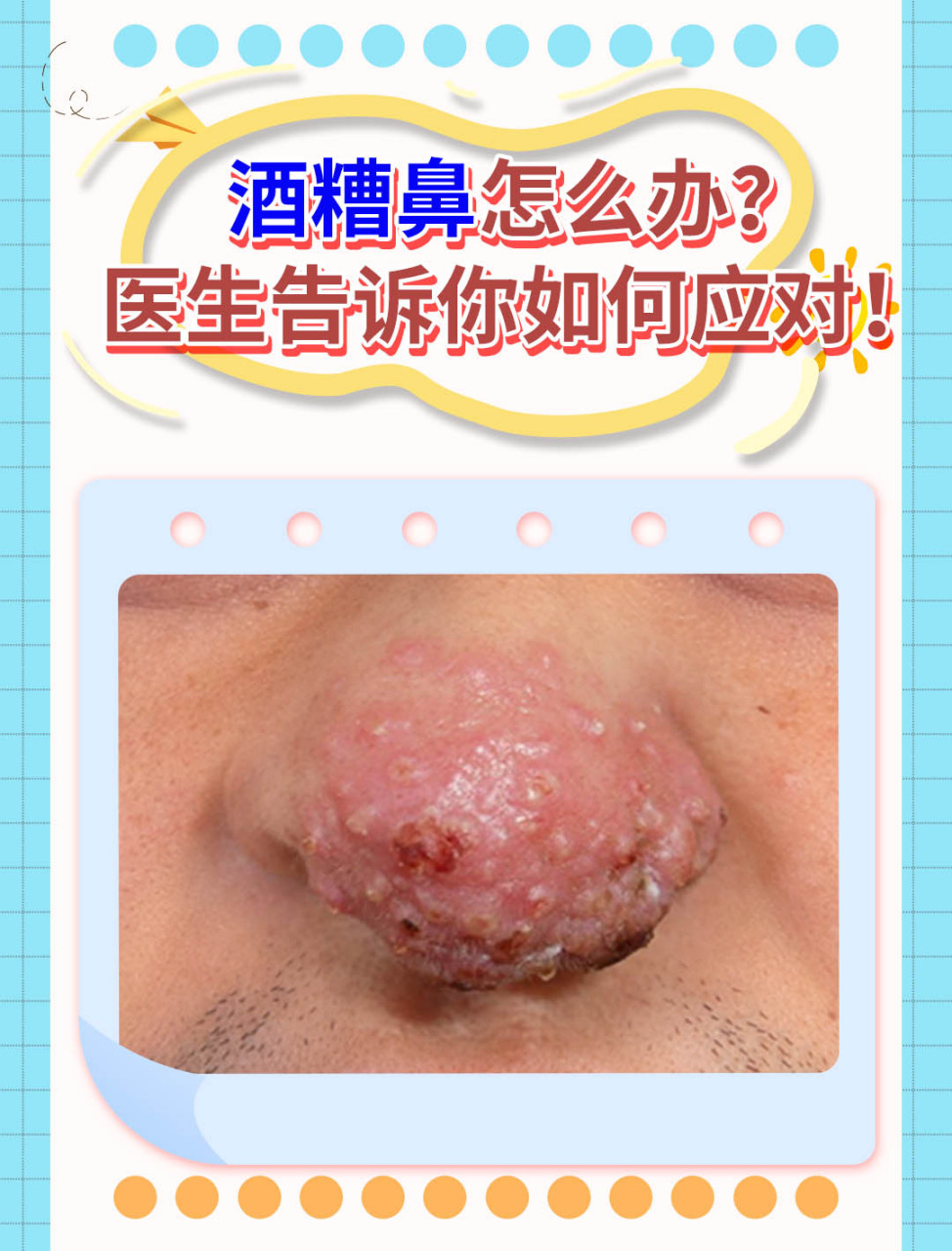 💥酒糟鼻也被称为玫瑰痤疮,是一种主要发生于面部中央的慢性炎症