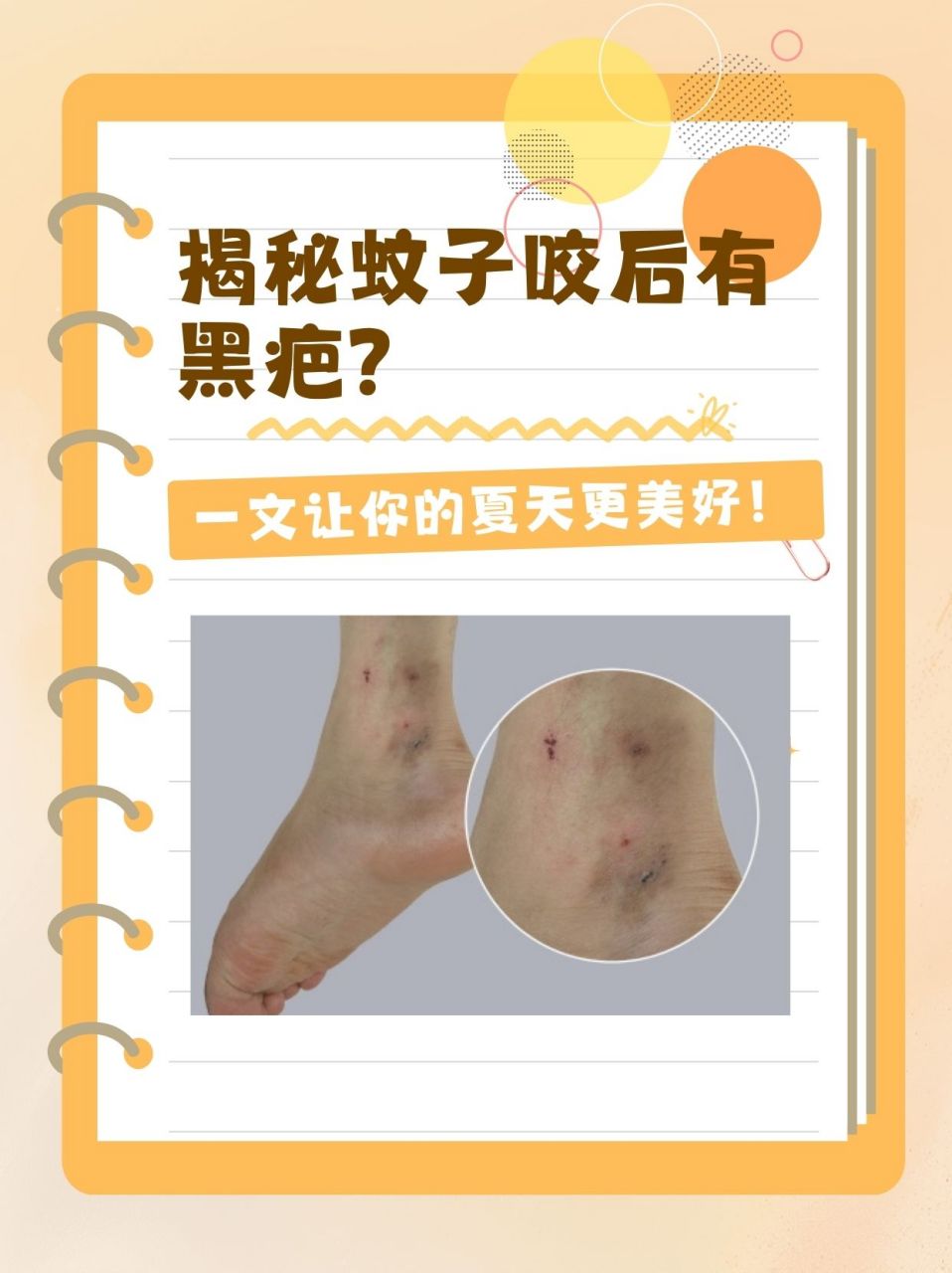 揭秘蚊子咬后有黑疤?一文让你的夏天更美好!