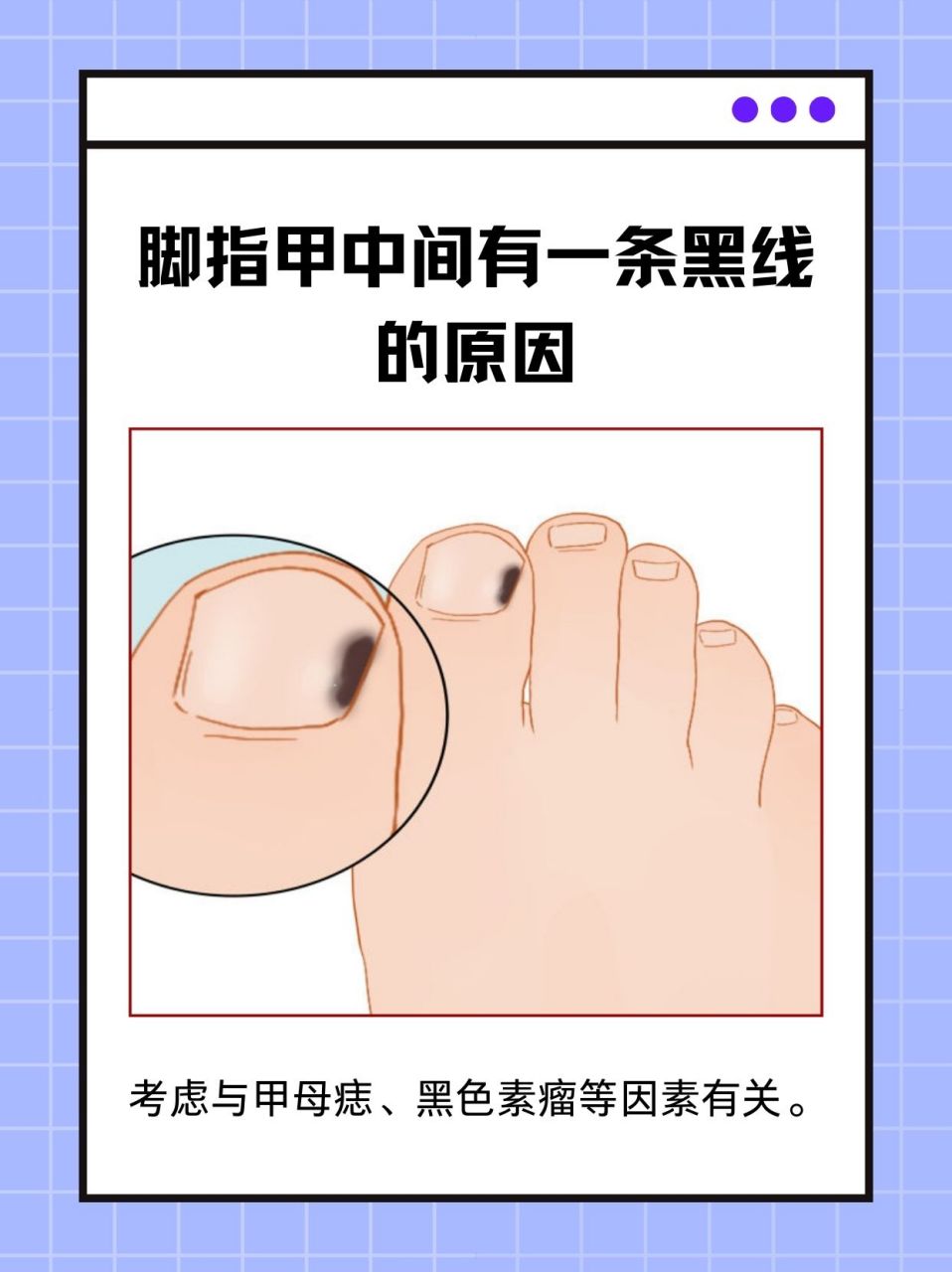 93脚指甲中间有一条黑线可能与外伤,甲母痣,黑色素瘤等因素有关.