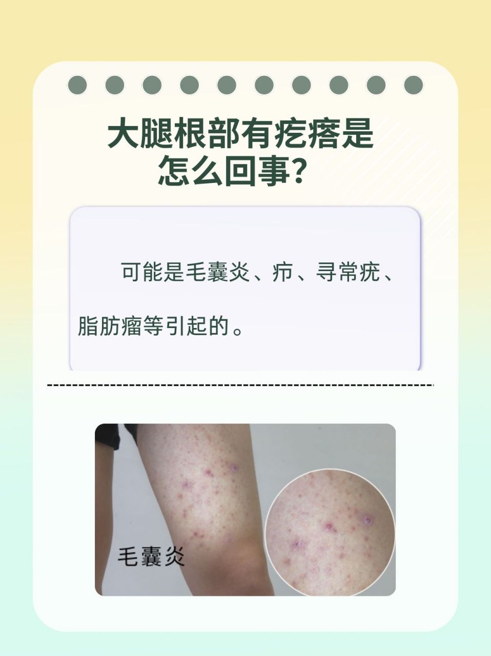 93大腿根部有疙瘩可能是毛囊炎,疖,寻常疣,皮脂腺囊肿,脂肪瘤等