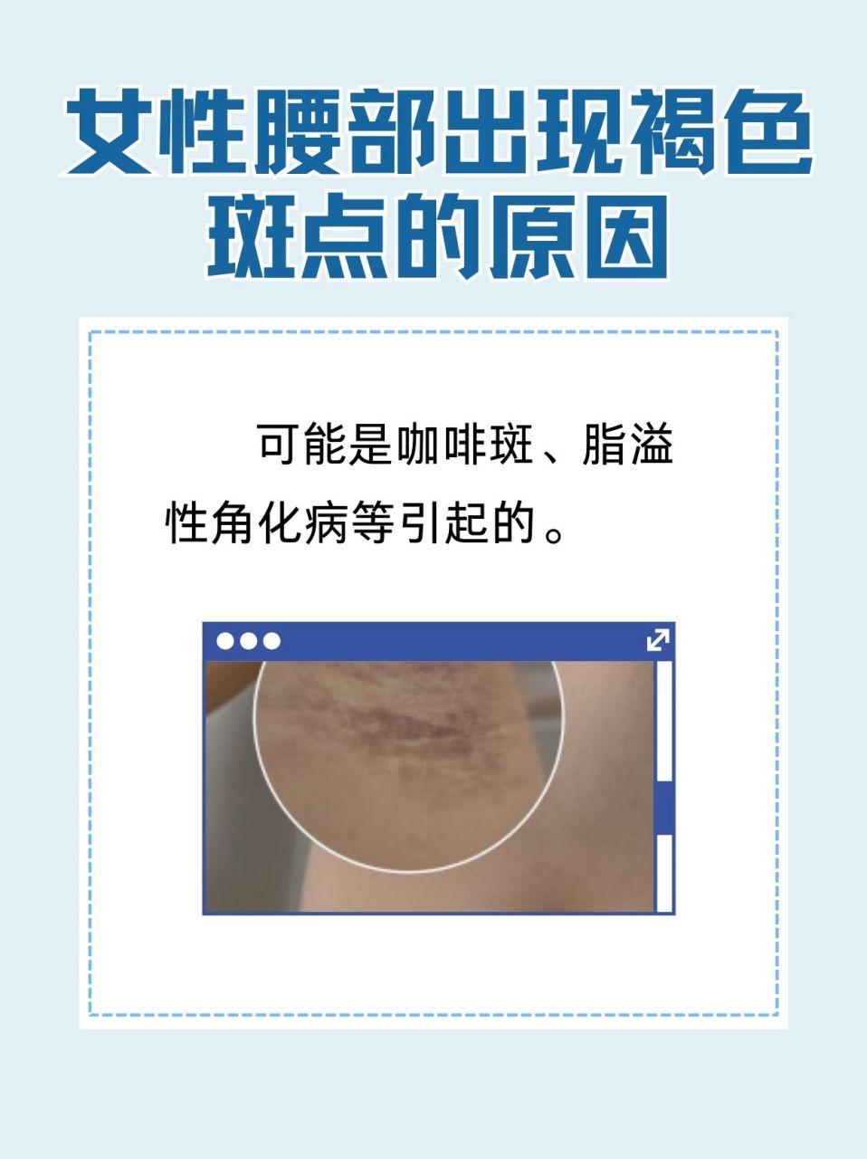 99697115女性腰部出现褐色斑点可能是咖啡斑,药物反应