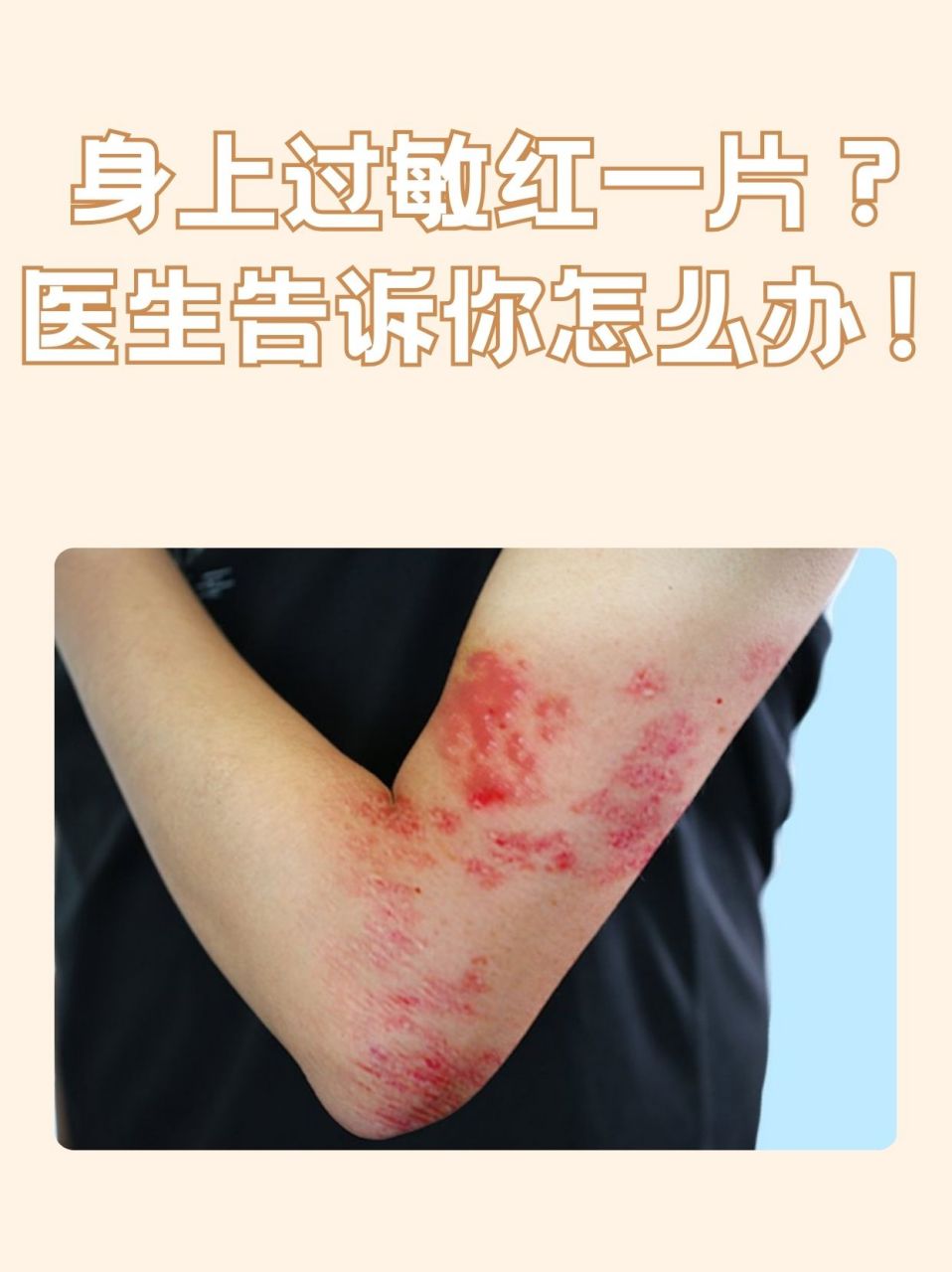 医生告诉你怎么办!   🍂身上过敏红一片多考虑是红疹.
